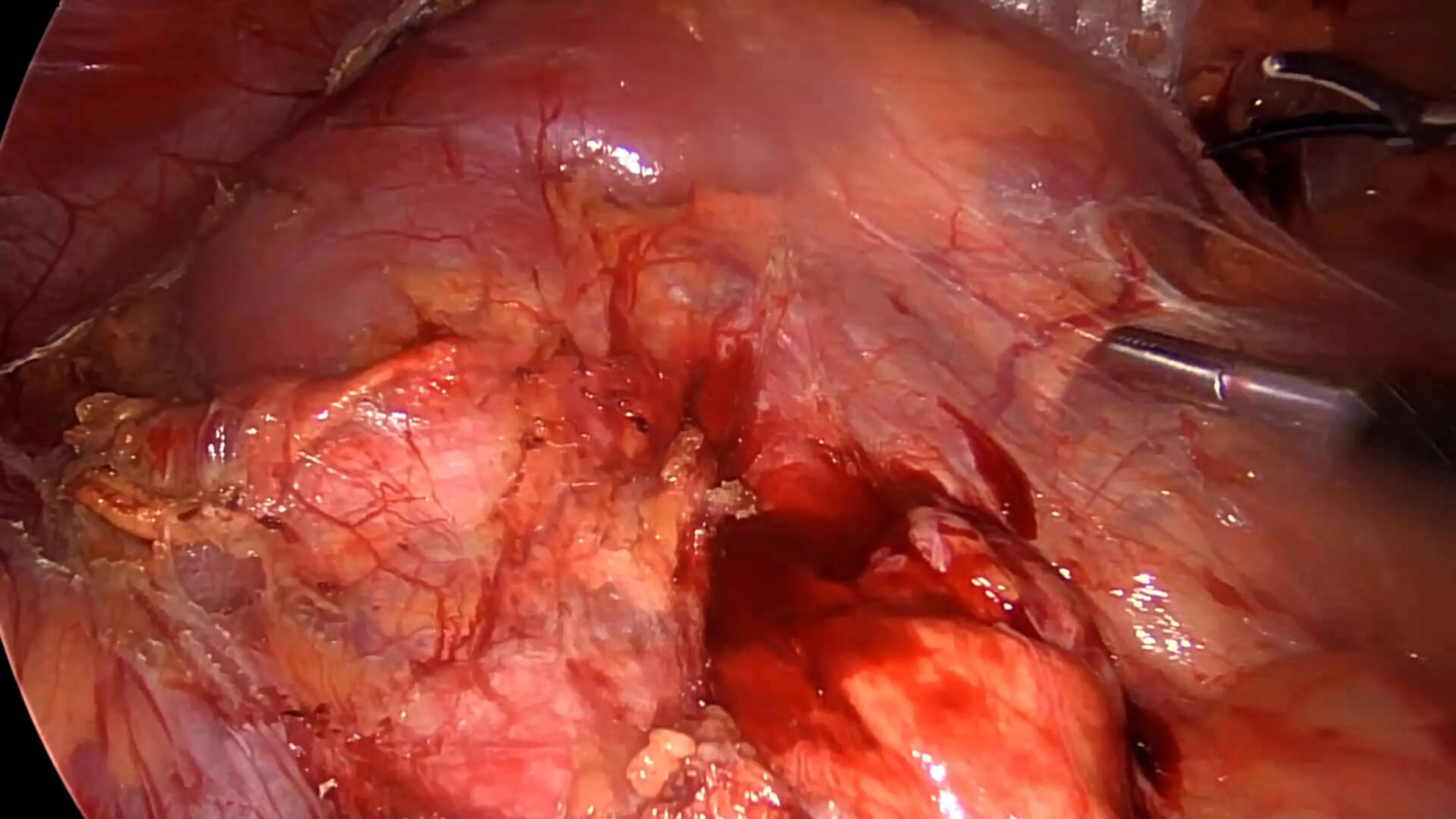 Left kidney identified