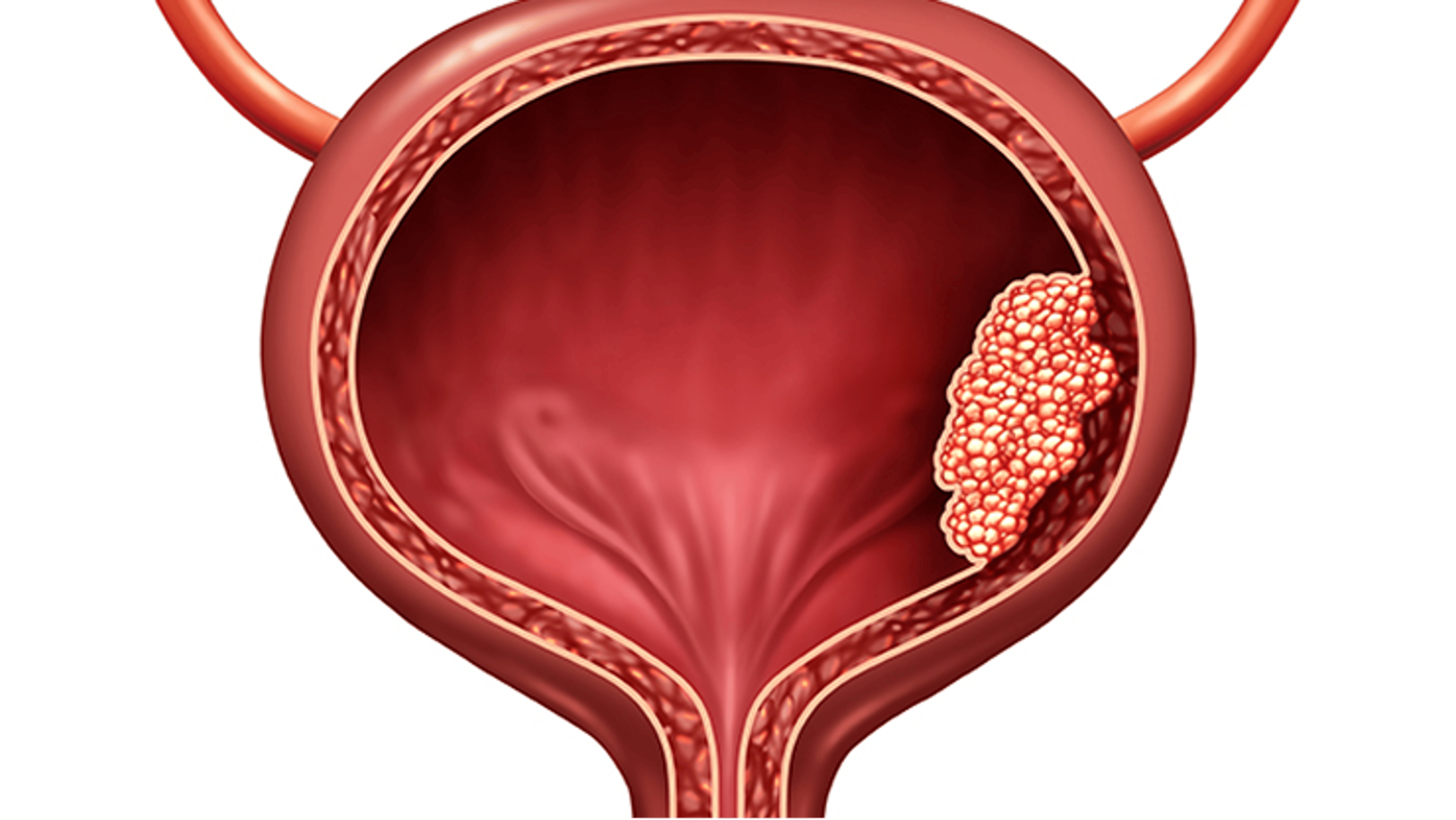 Bacillus Calmette–Guérin-Unresponsive Non–Muscle Invasive Bladder Cancer with Carcinoma In Situ (BCG-UR NMIBC CIS)
