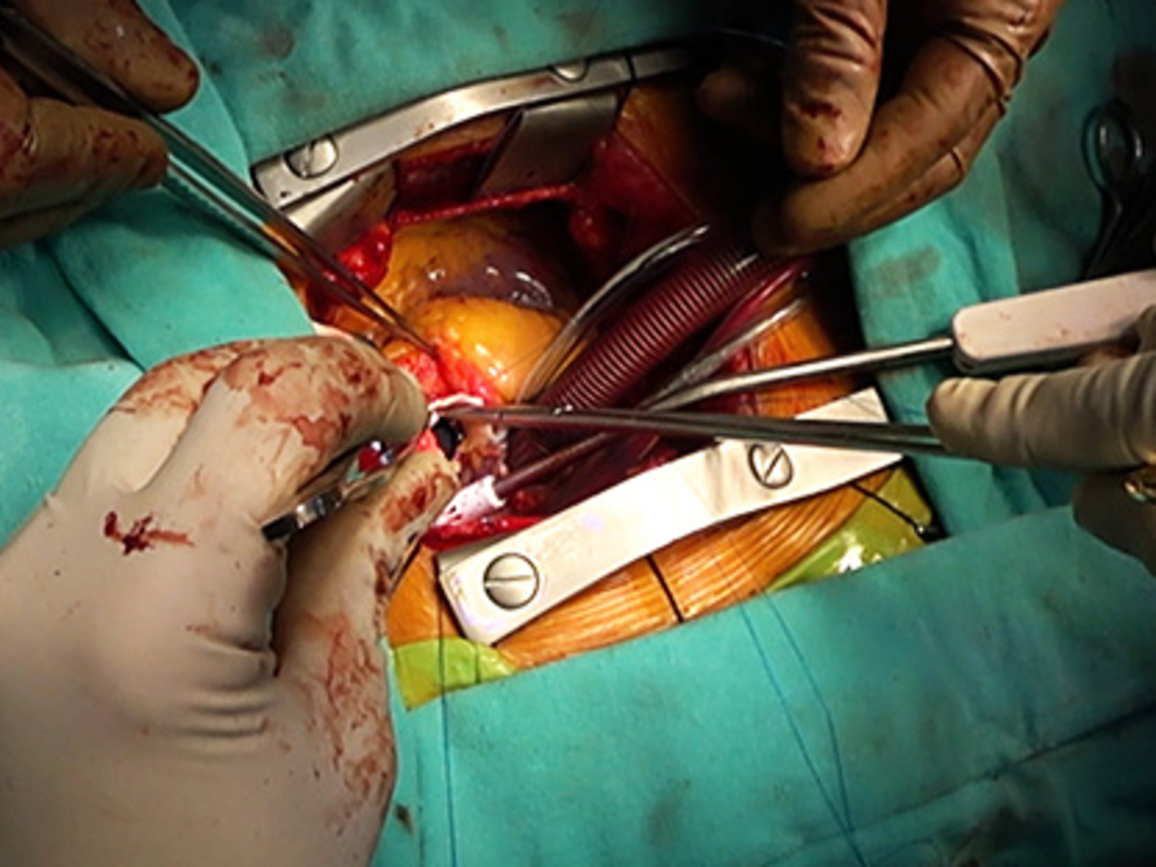 Aortic valve replacement with Thomas Martella, MD and Bob Kiaii, MD