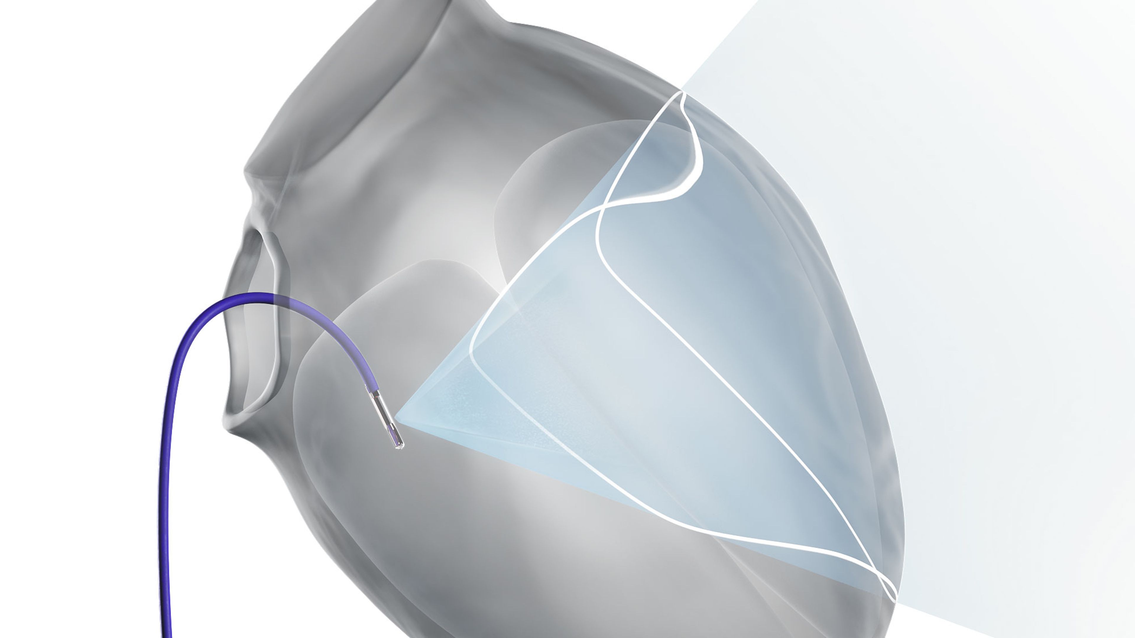 CARTOSOUND SONATA™ Module rendering showing catheter in the heart.