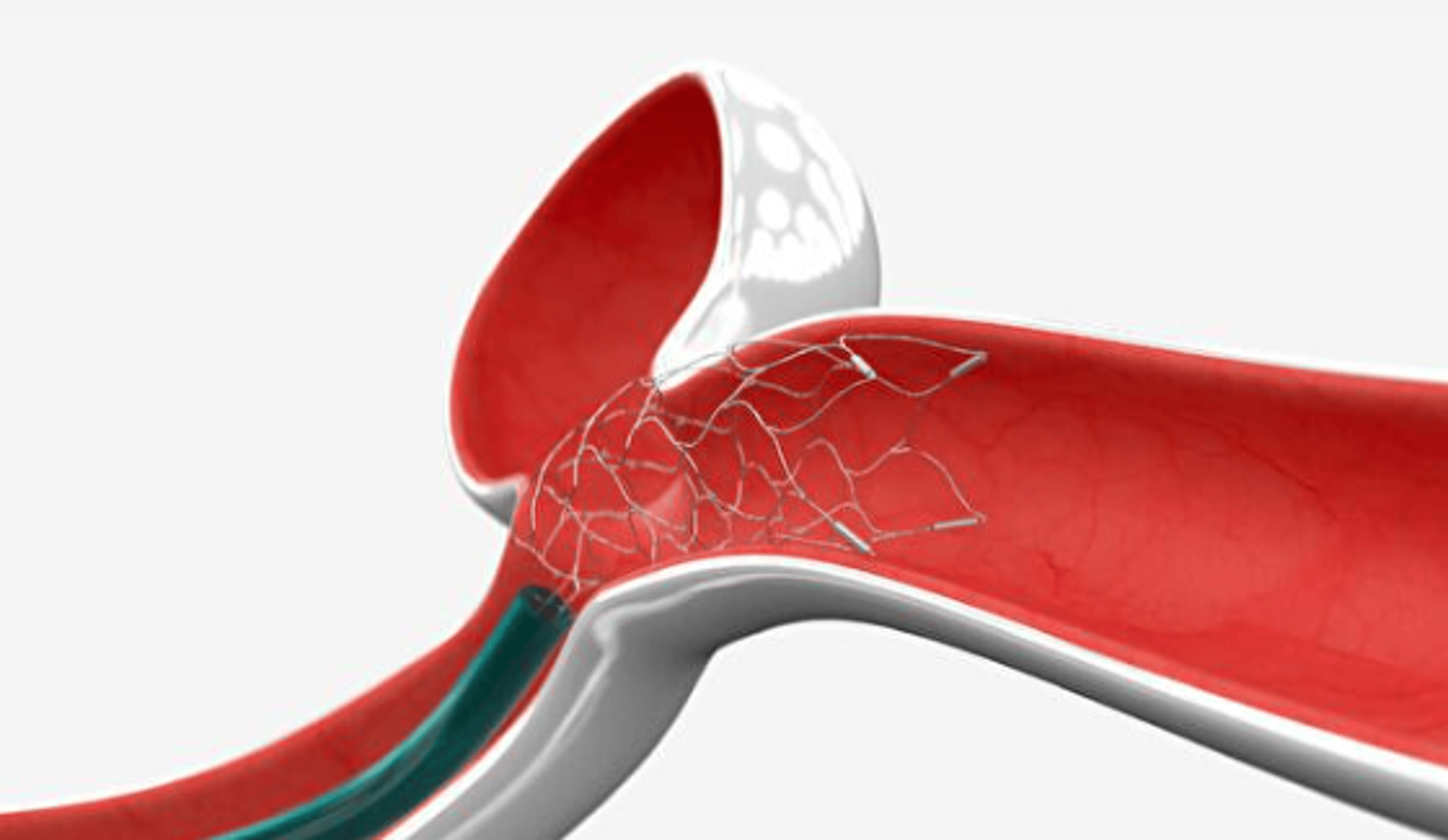CEREGLIDE™ 71 Intermediate Catheter with TruCourse™