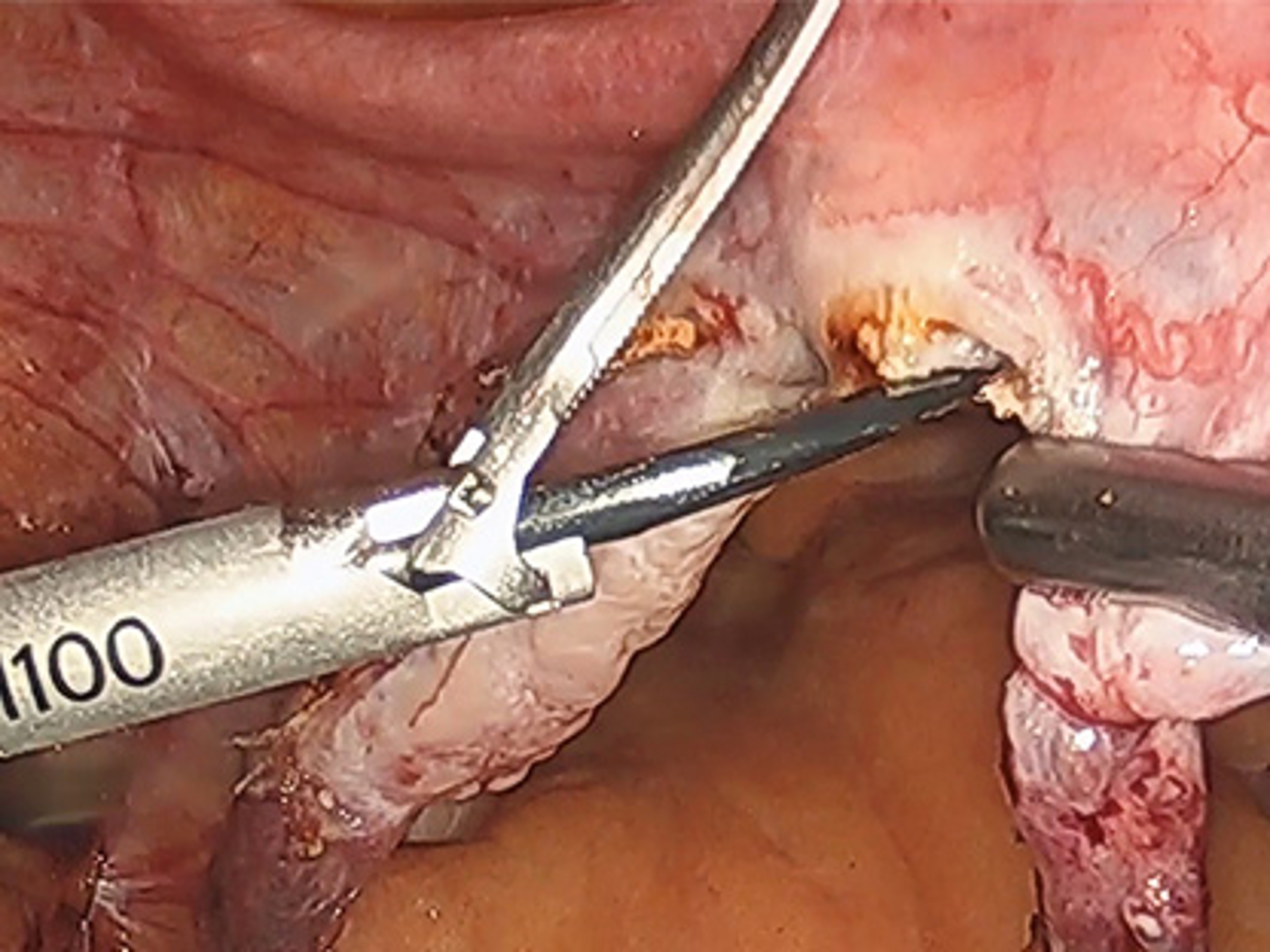 Total laparoscopic hysterectomy with Grace Chen, MD