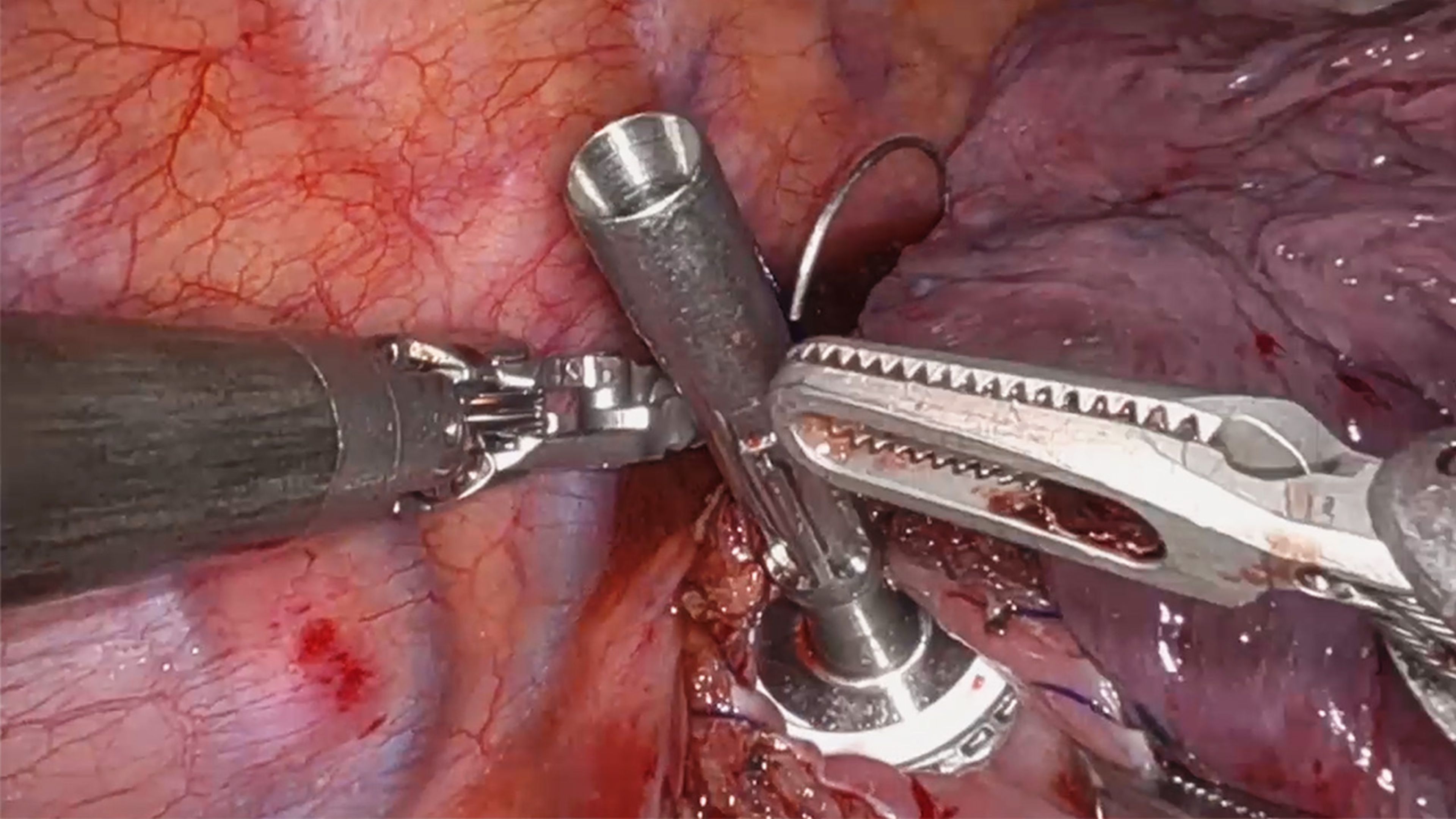 US_SRG_STAP_403155 - Esophageal Anastomosis After Esophagectomy Using the ETHICON™ CIRCULAR Stapler with Olugbenga Okusanya, MD