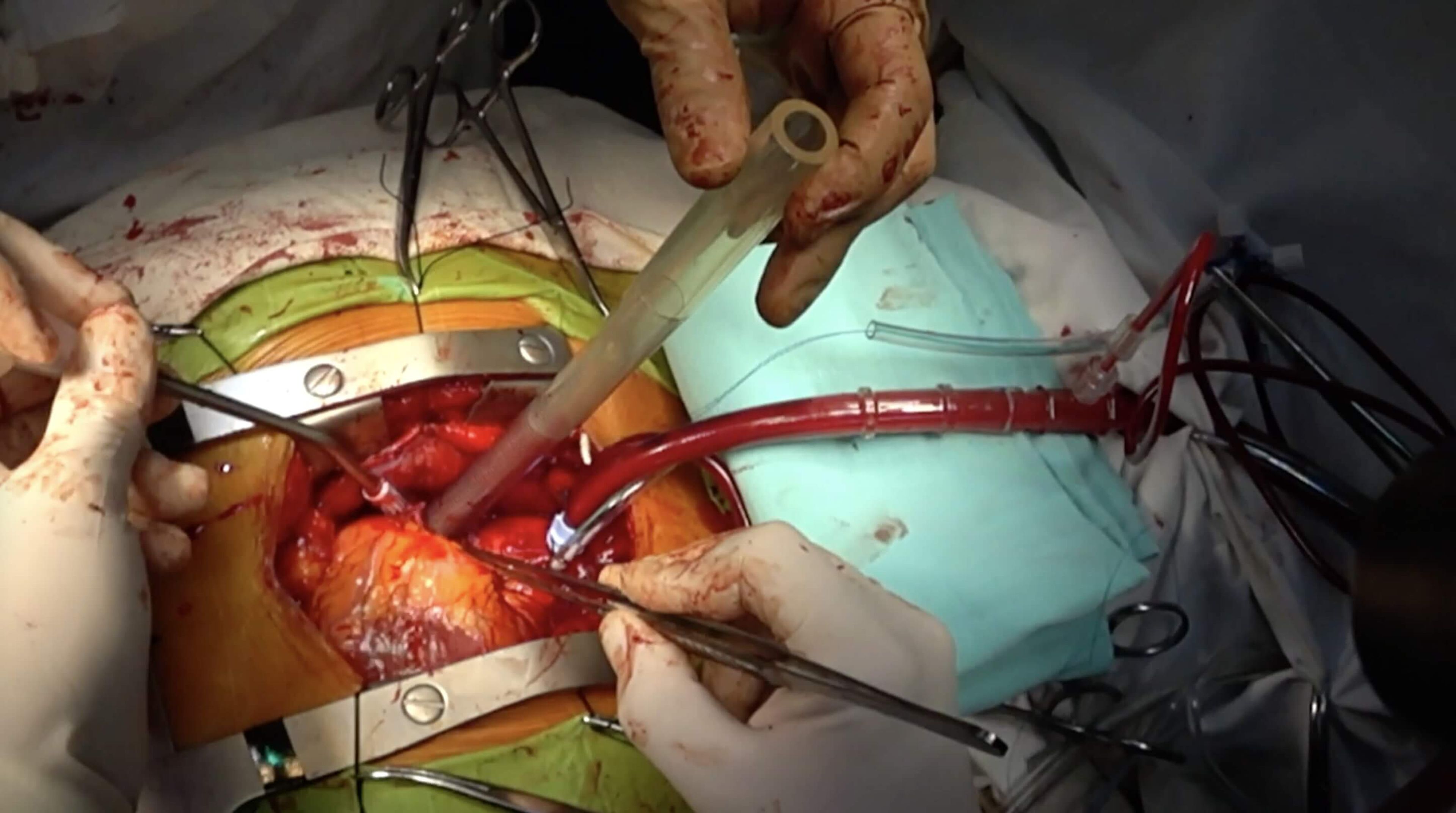 Atrial Cannula