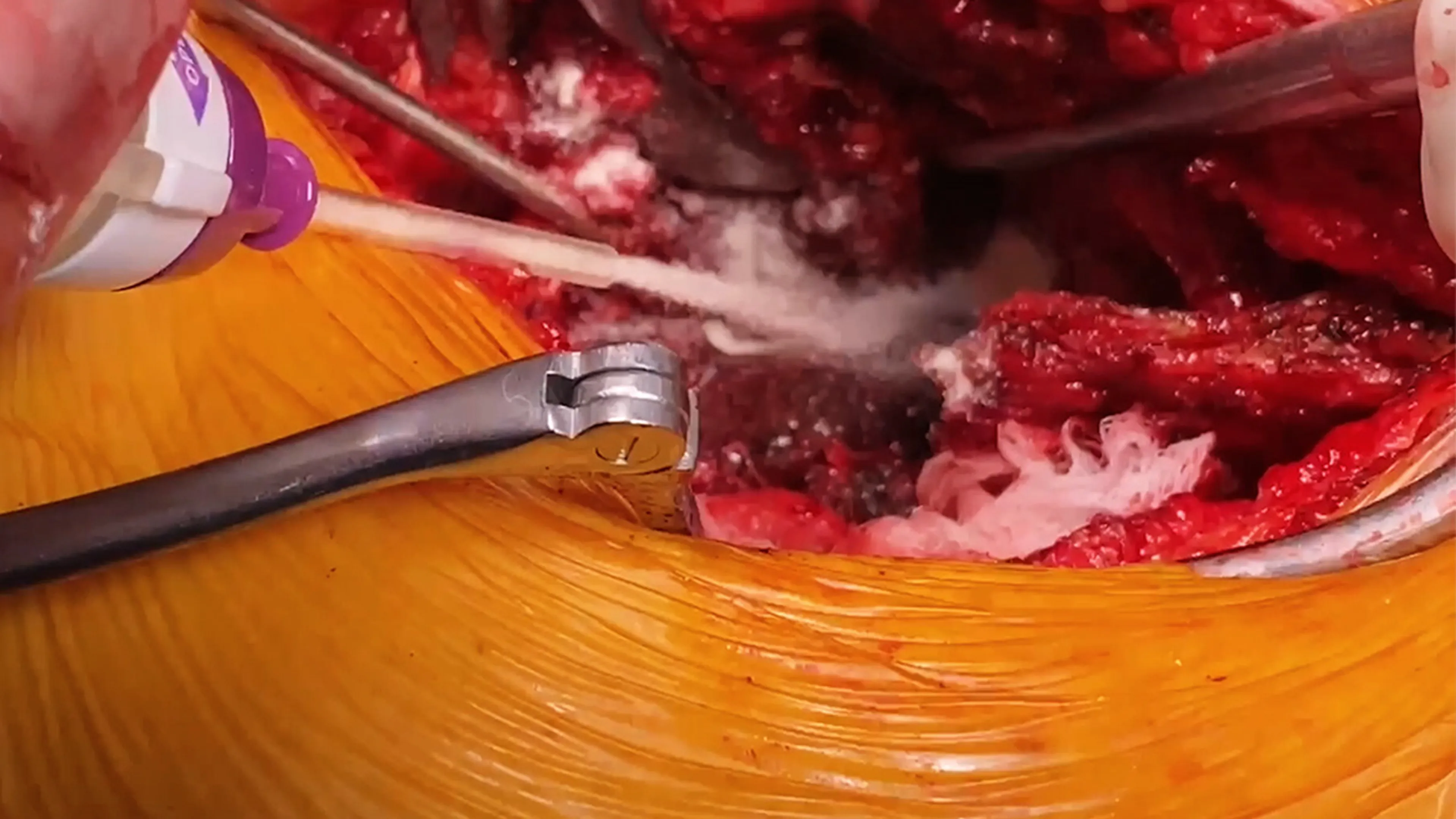 US_ETH_BIOS_379015 - SURGICEL™ Powder Absorbable Hemostat in a Spine Procedure with Michael Wang, MD