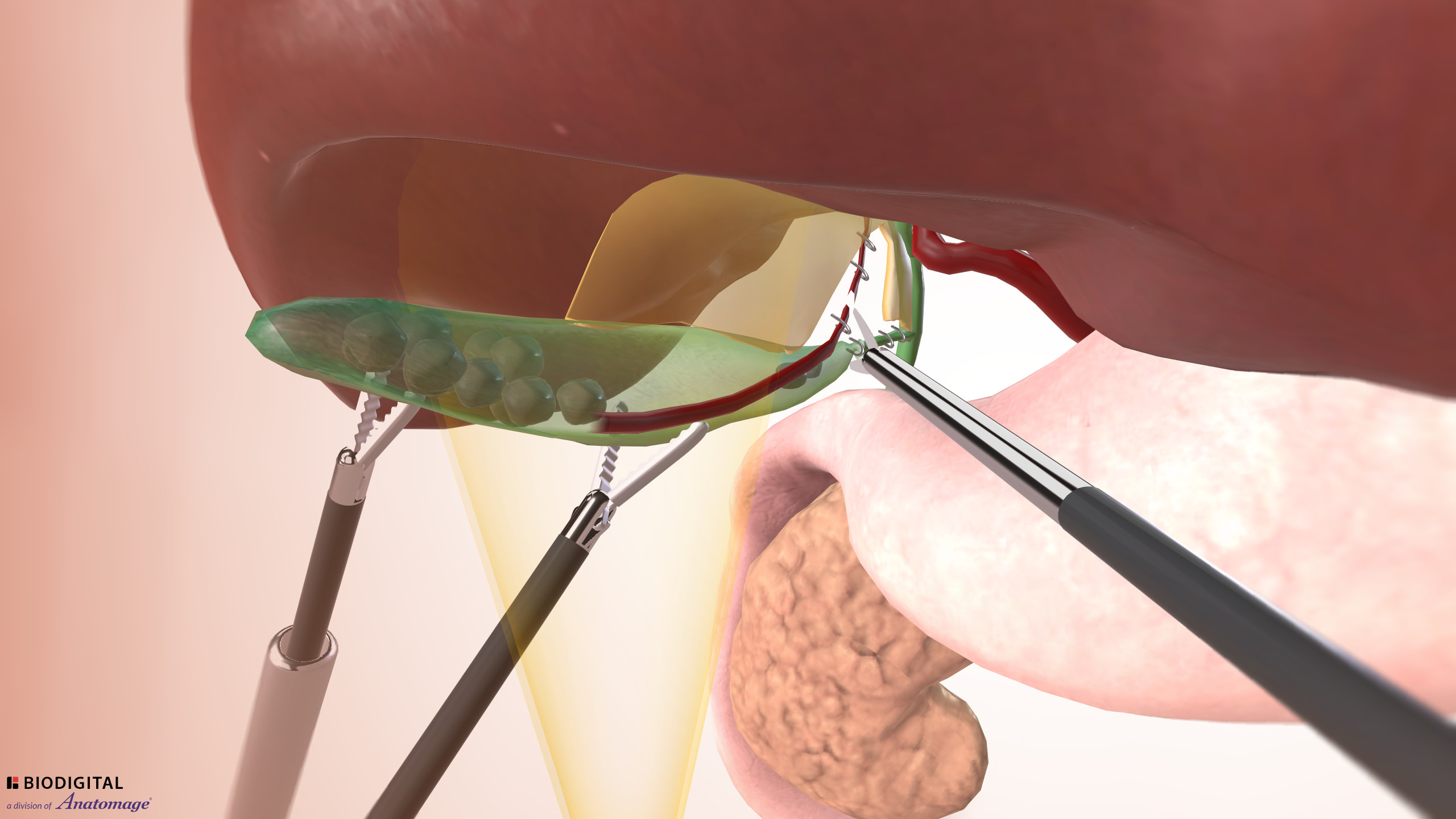 Laparoscopic Cholecystectomy