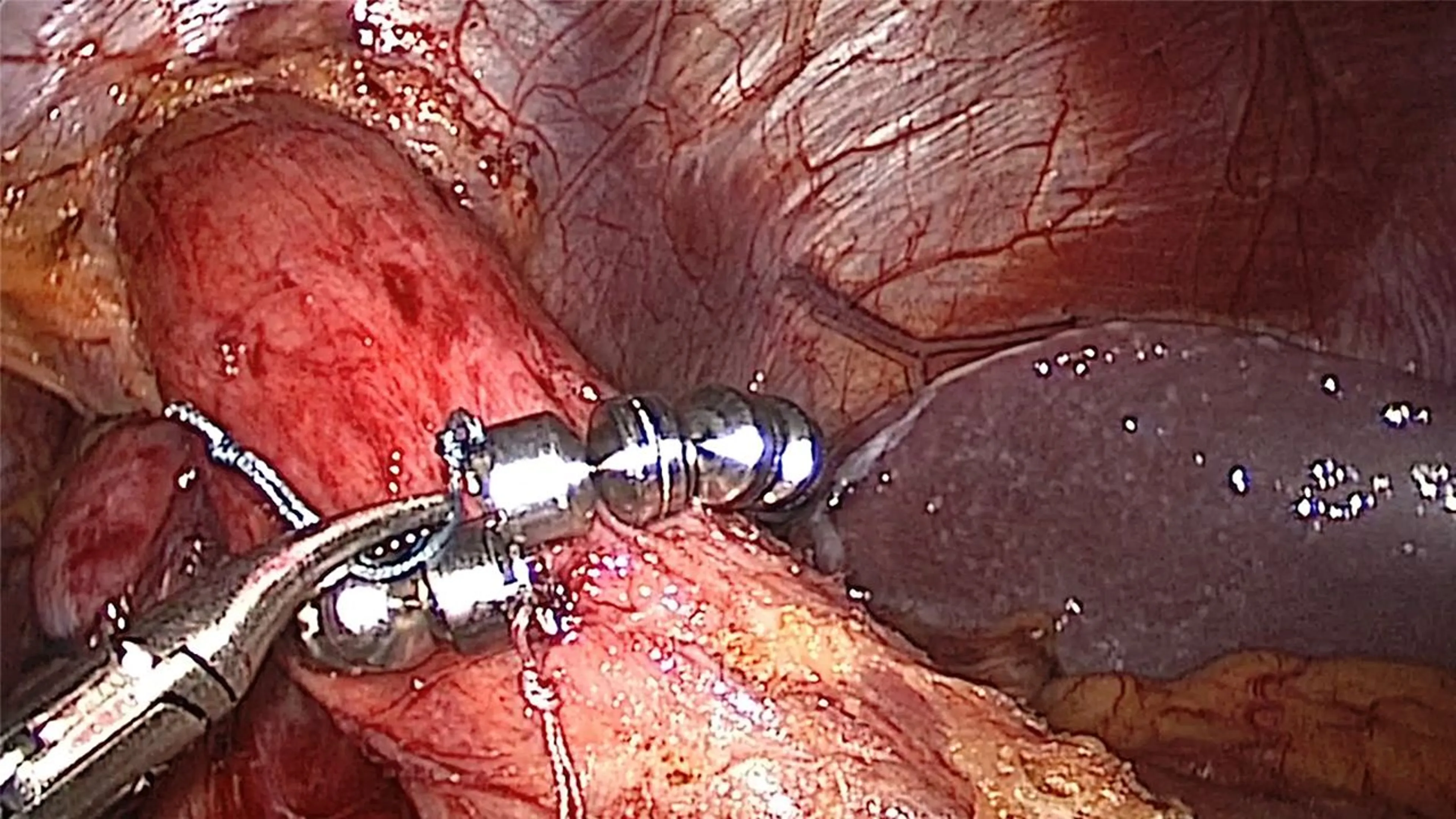 US_ETH_LINX_126727 - Hiatal Hernia Repair and Linx™ Placement with John Lipham, MD