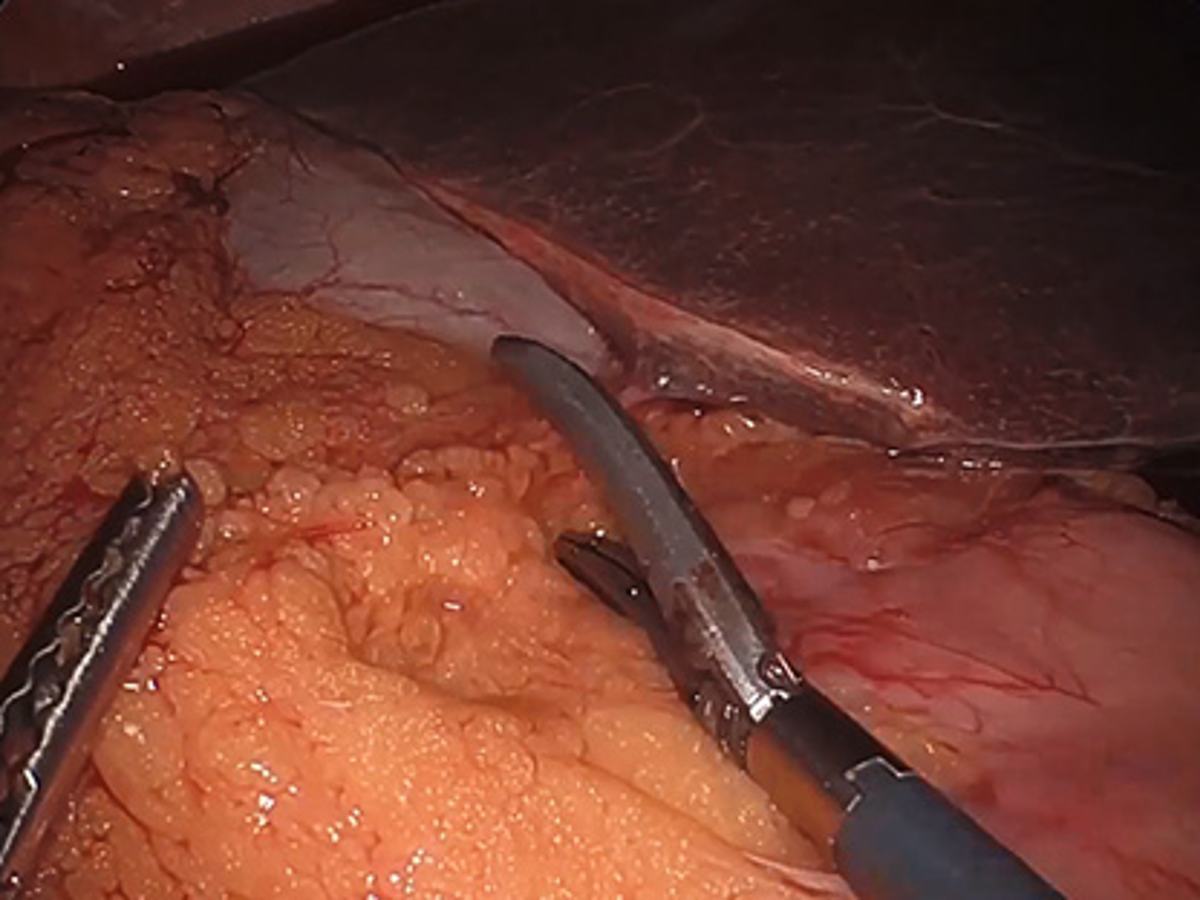 Laparoscopic right hemicolectomy