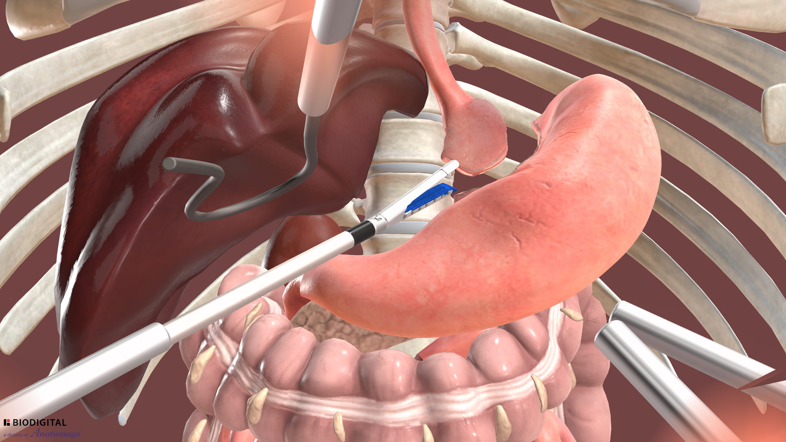 Laparoscopic Roux-en-Y Gastric Bypass