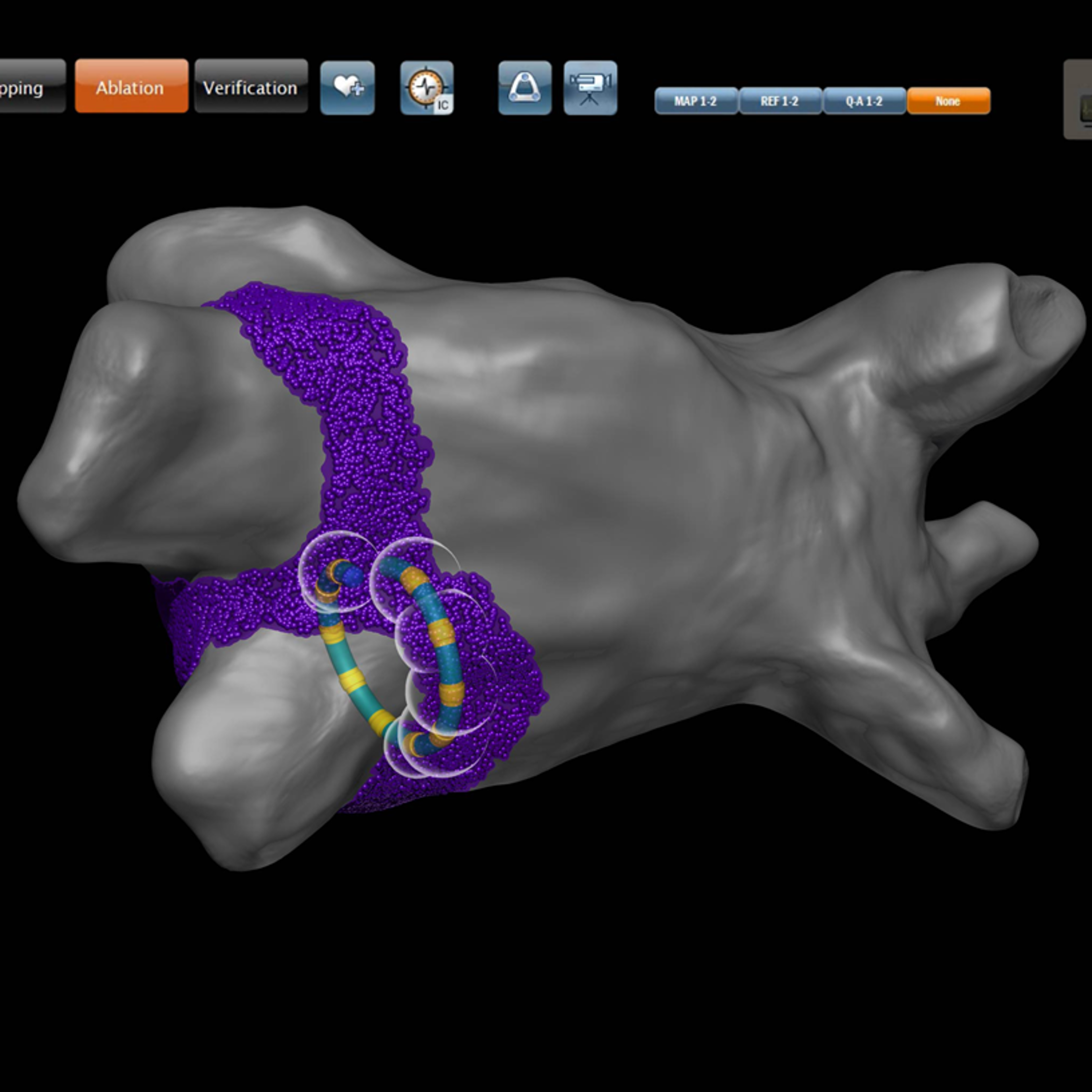 VARIPULSE™ Catheter | J&J MedTech US