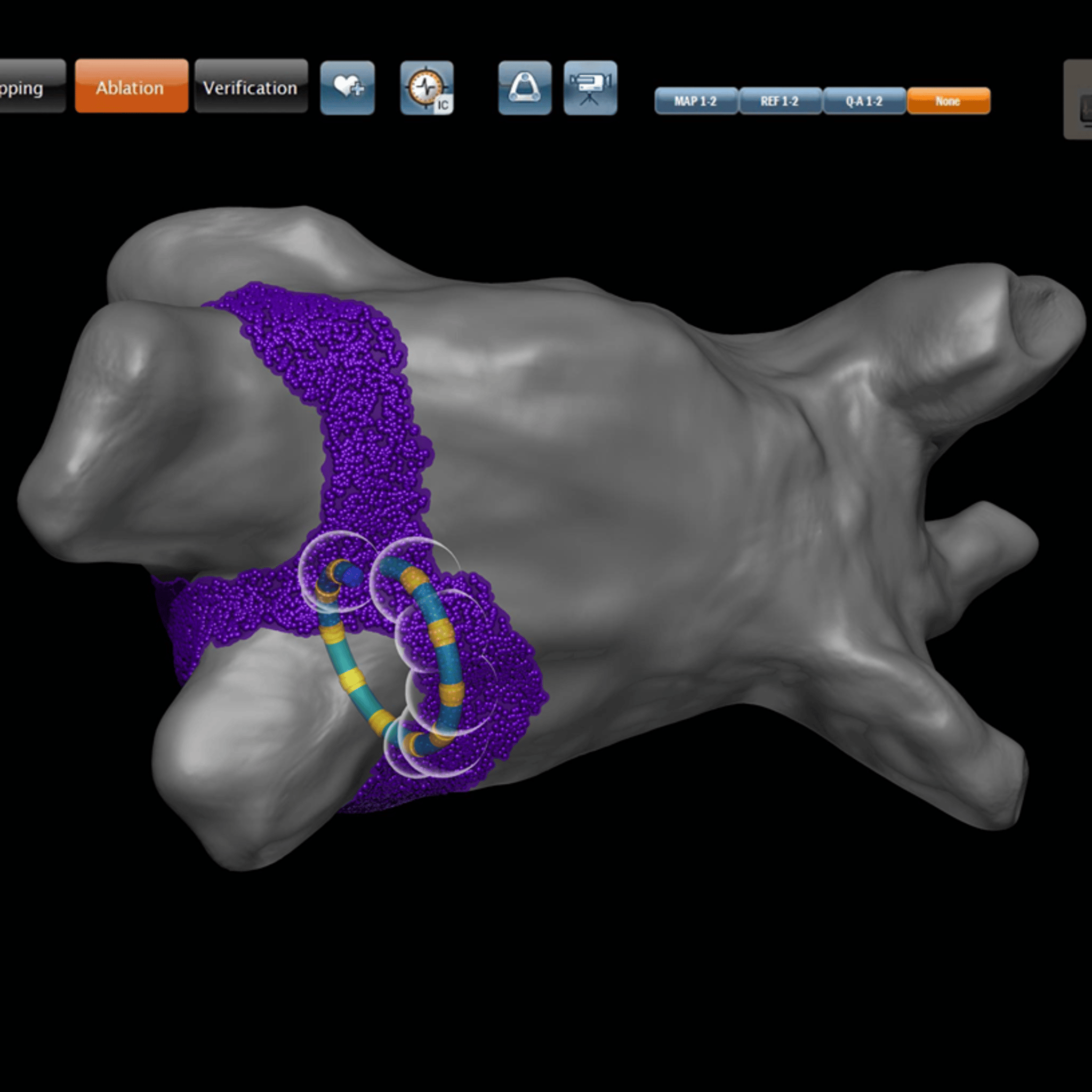Varapulse VARIPULSE™ Catheter | J&J MedTech US