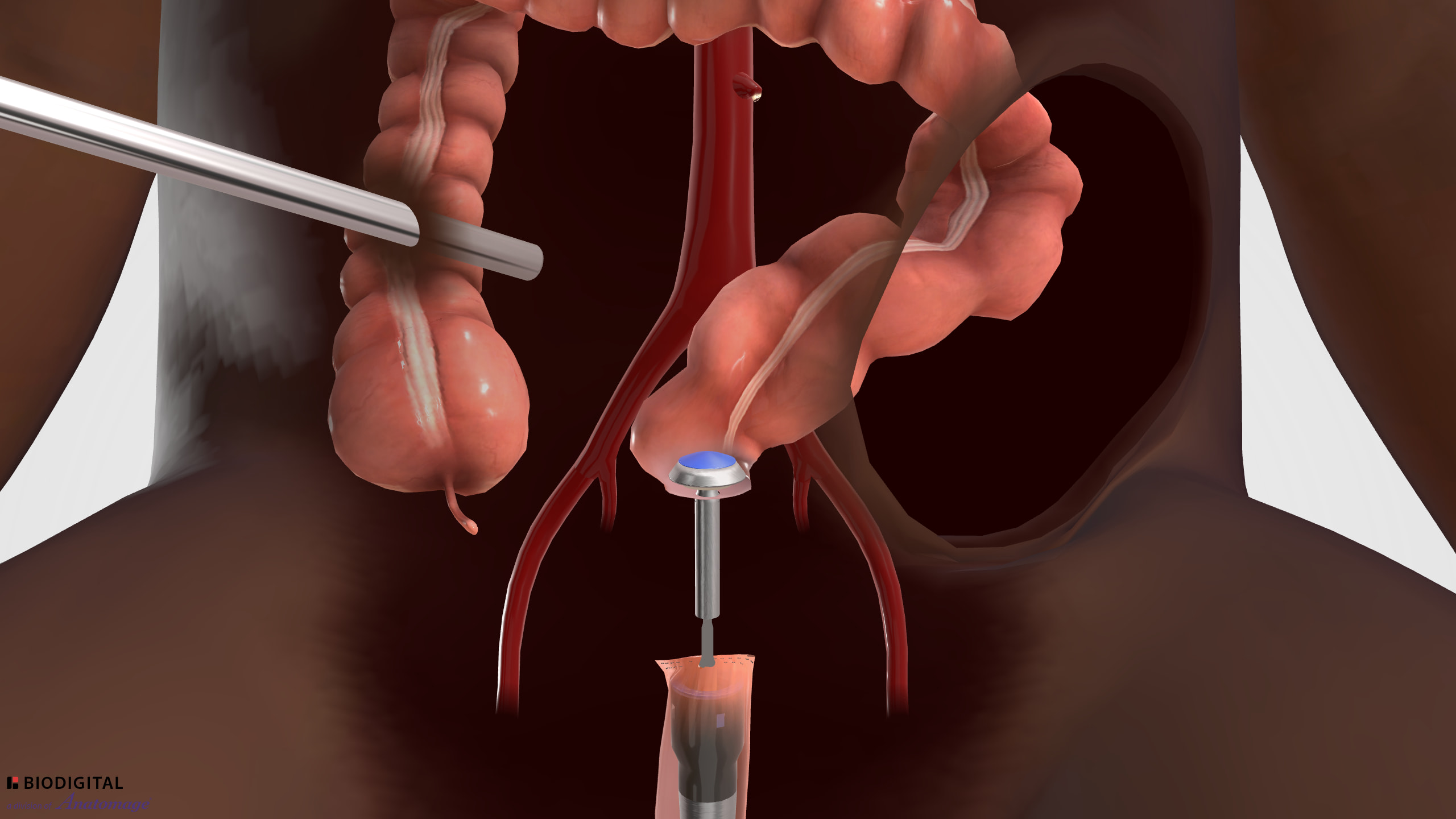 Laparoscopic Sigmoid Colectomy