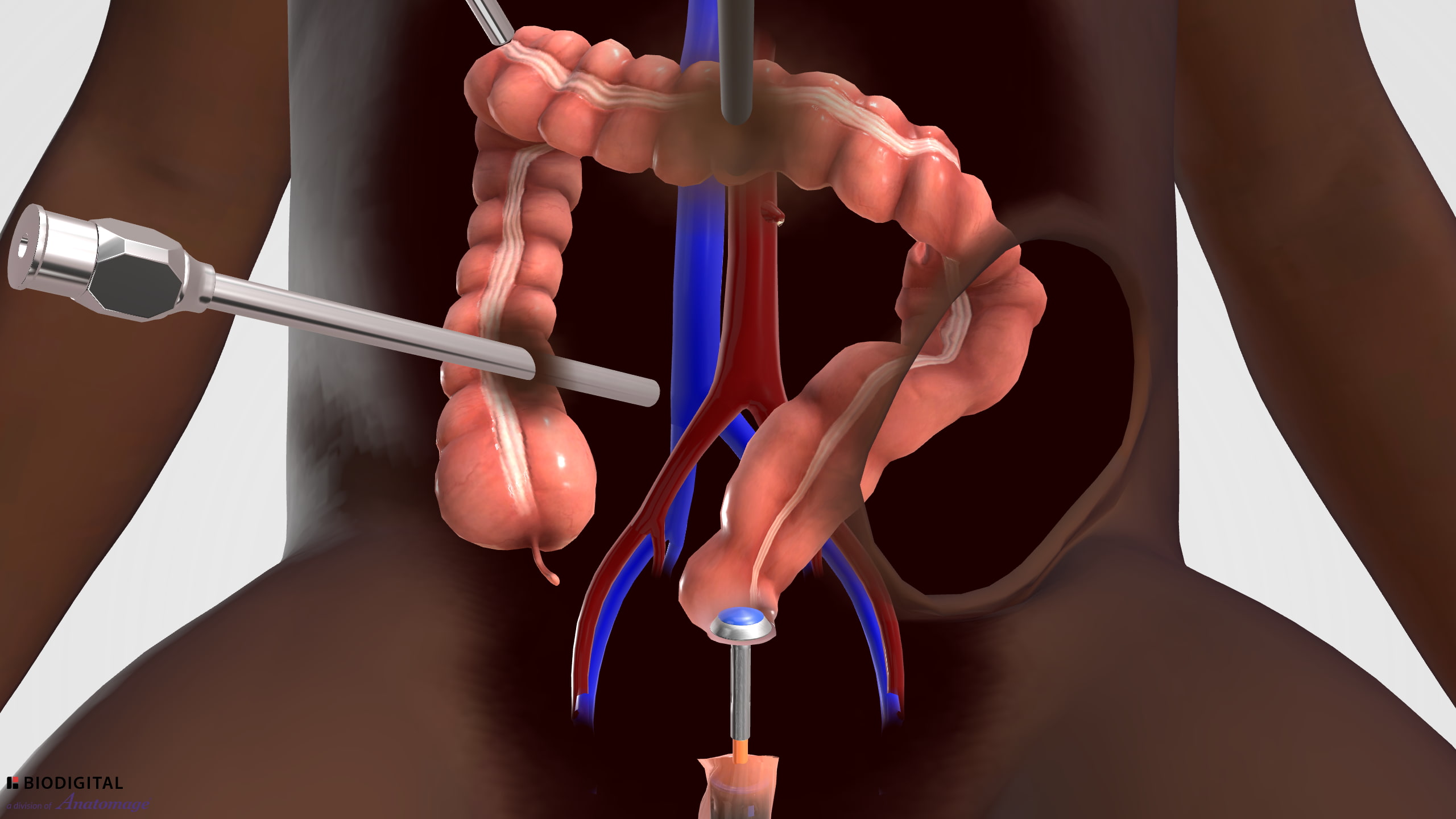 Lower anterior resection