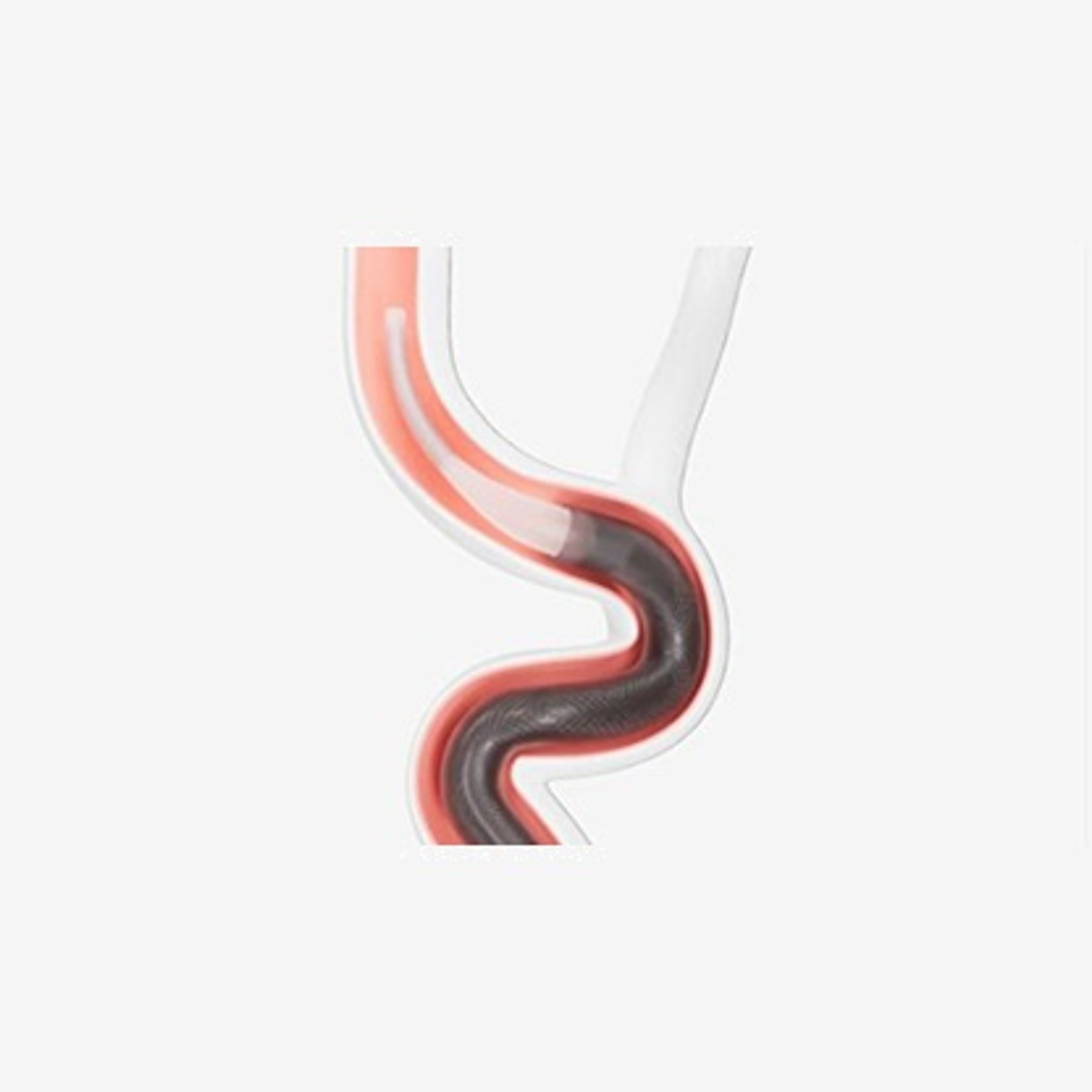 CEREGLIDE™ 92 Catheter System with TruCourse™