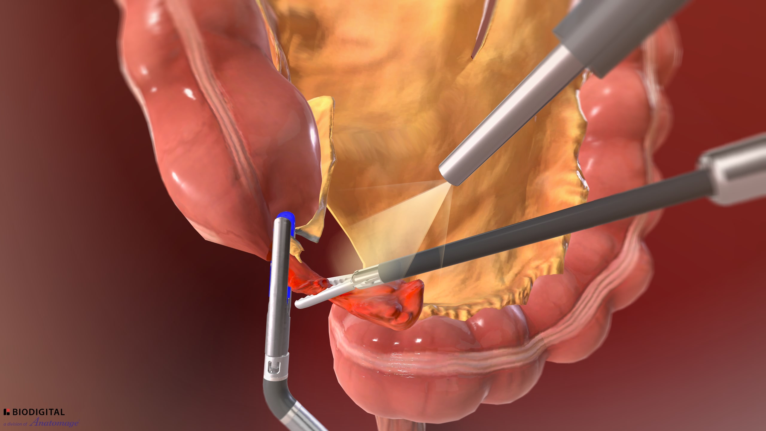 Laparoscopic appendectomy 3d model