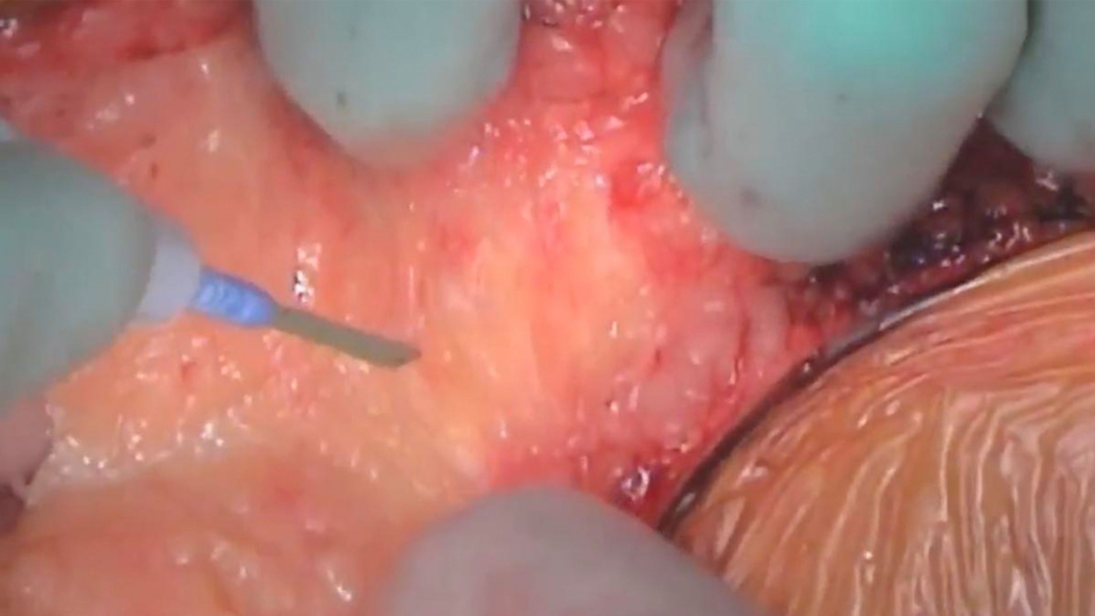 Transverse colon retracted