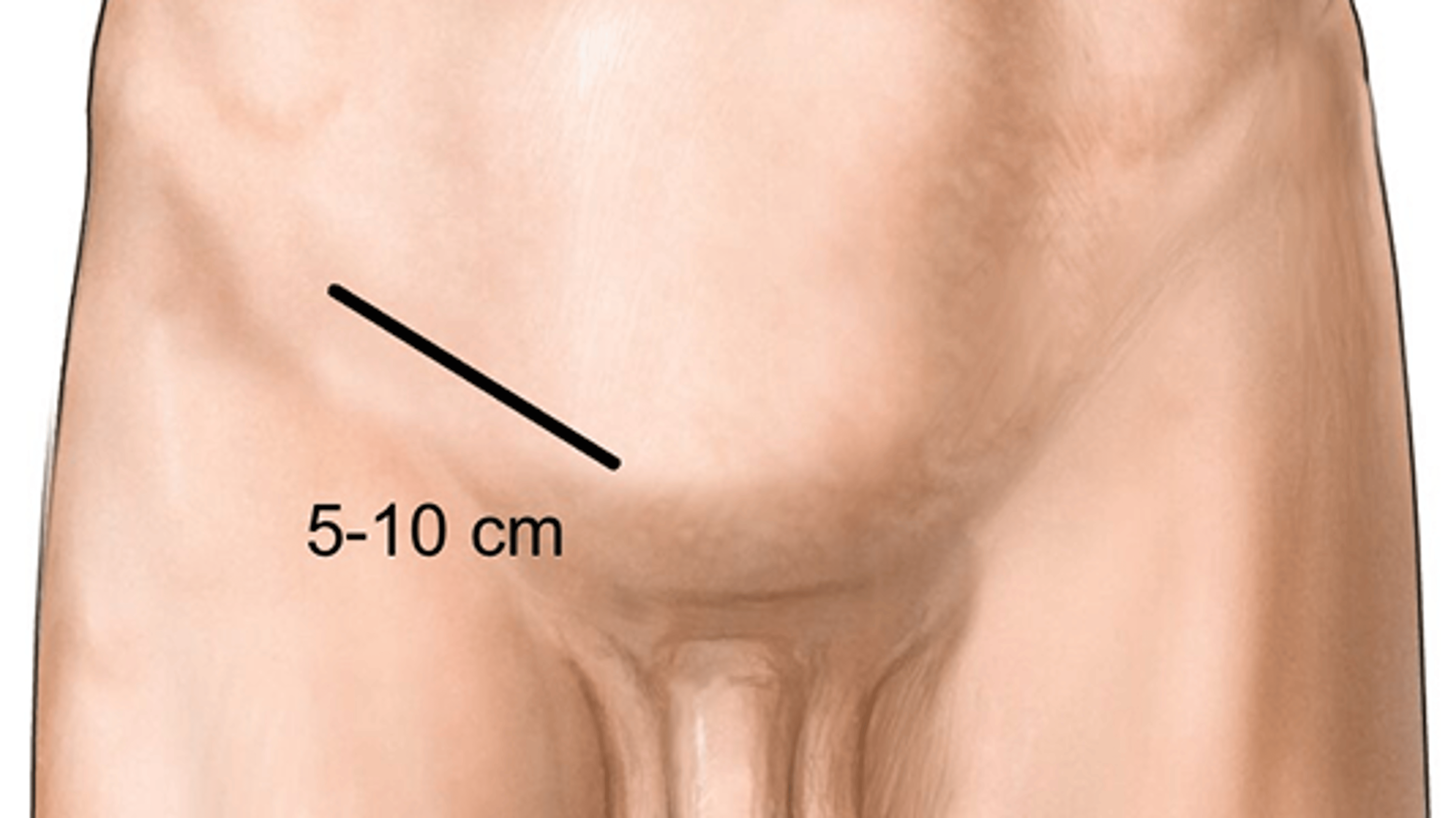 Incision site