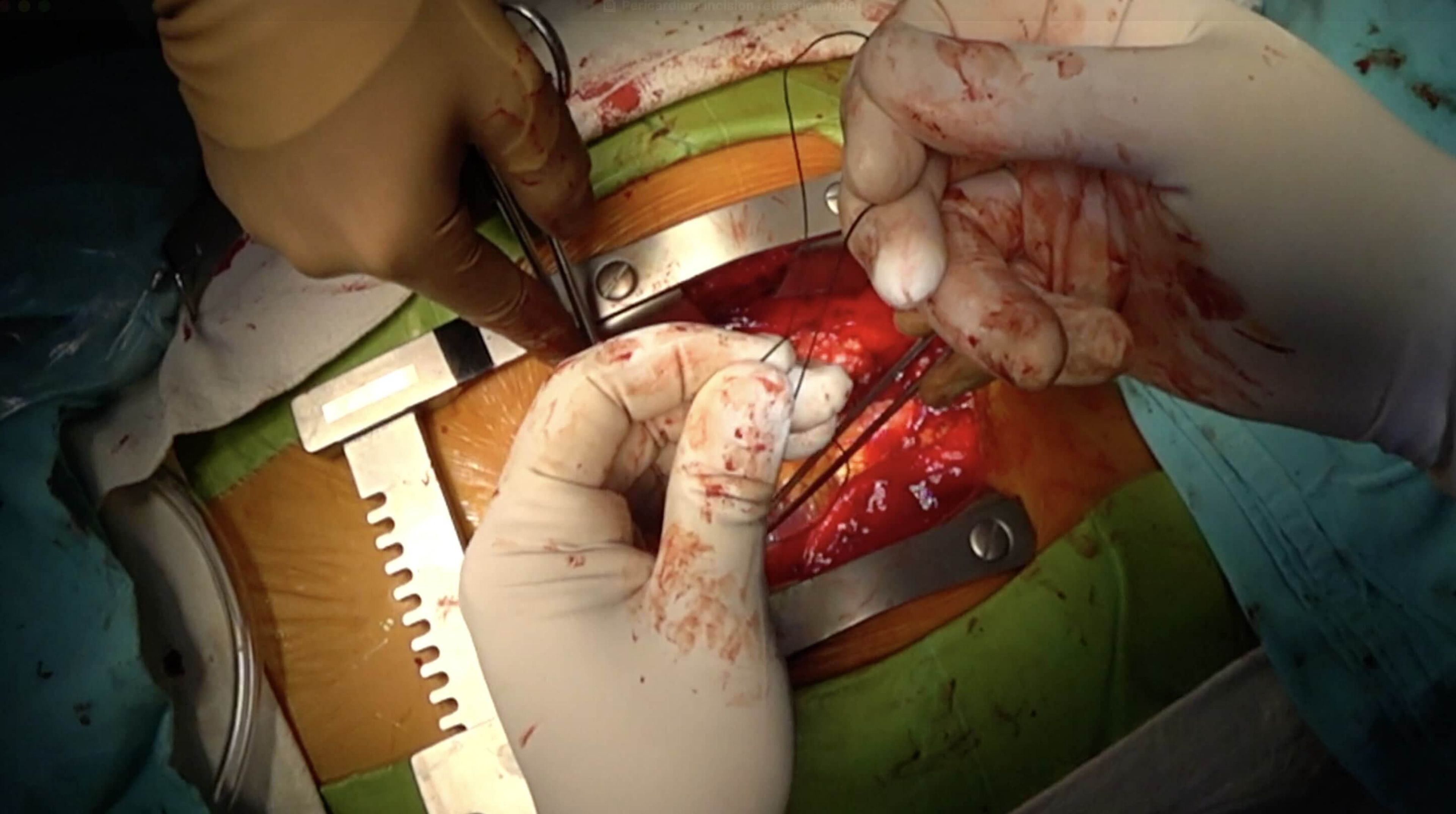 Pericardium incision retraction