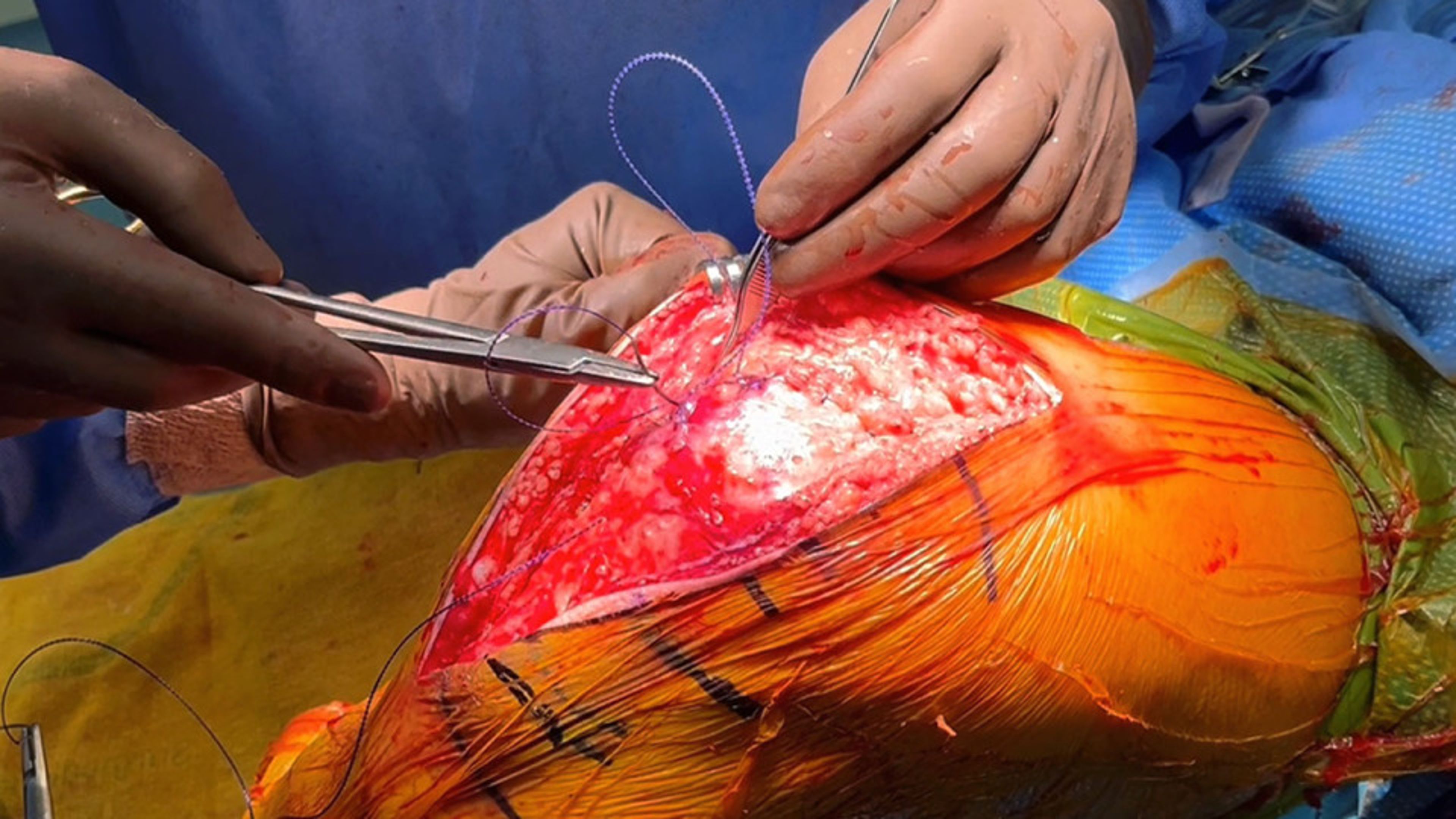 US_SRG_WOUN_408502 - Total knee arthroplasty using STRATAFIX™ Symmetric PDS™ Plus with Michael Muncy, DO