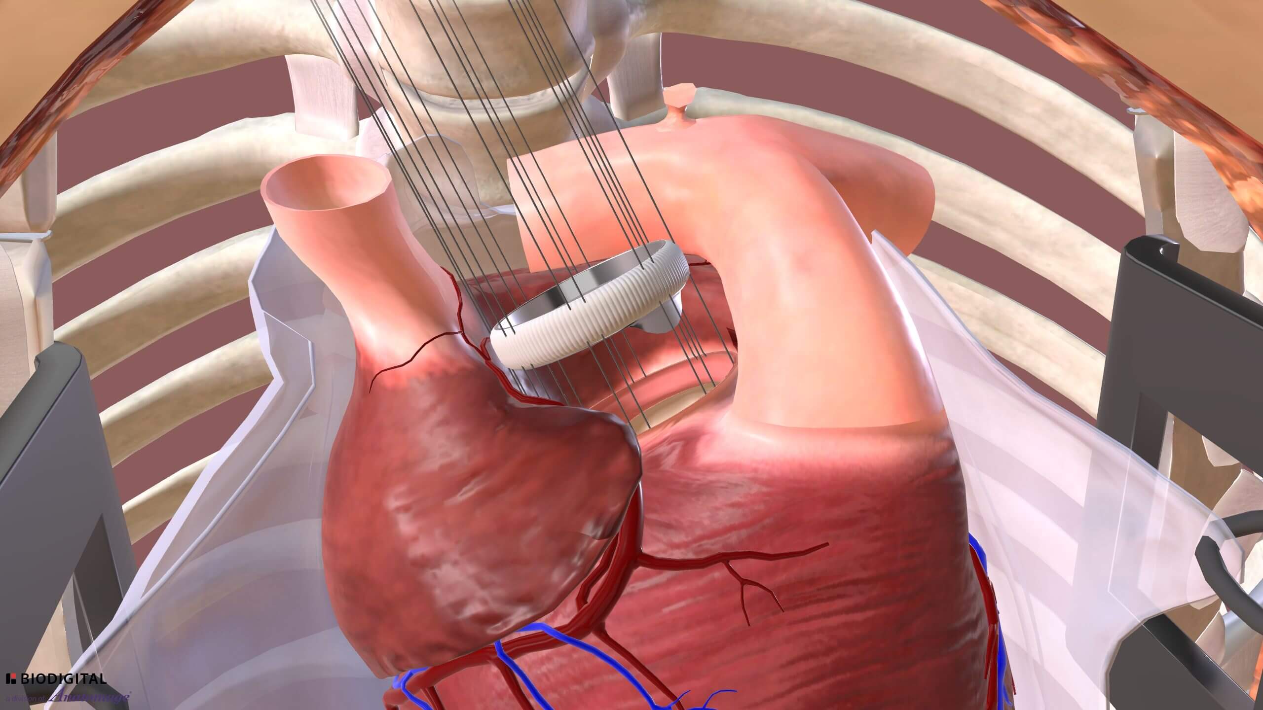 Relevant anatomy for aortic valve replacement