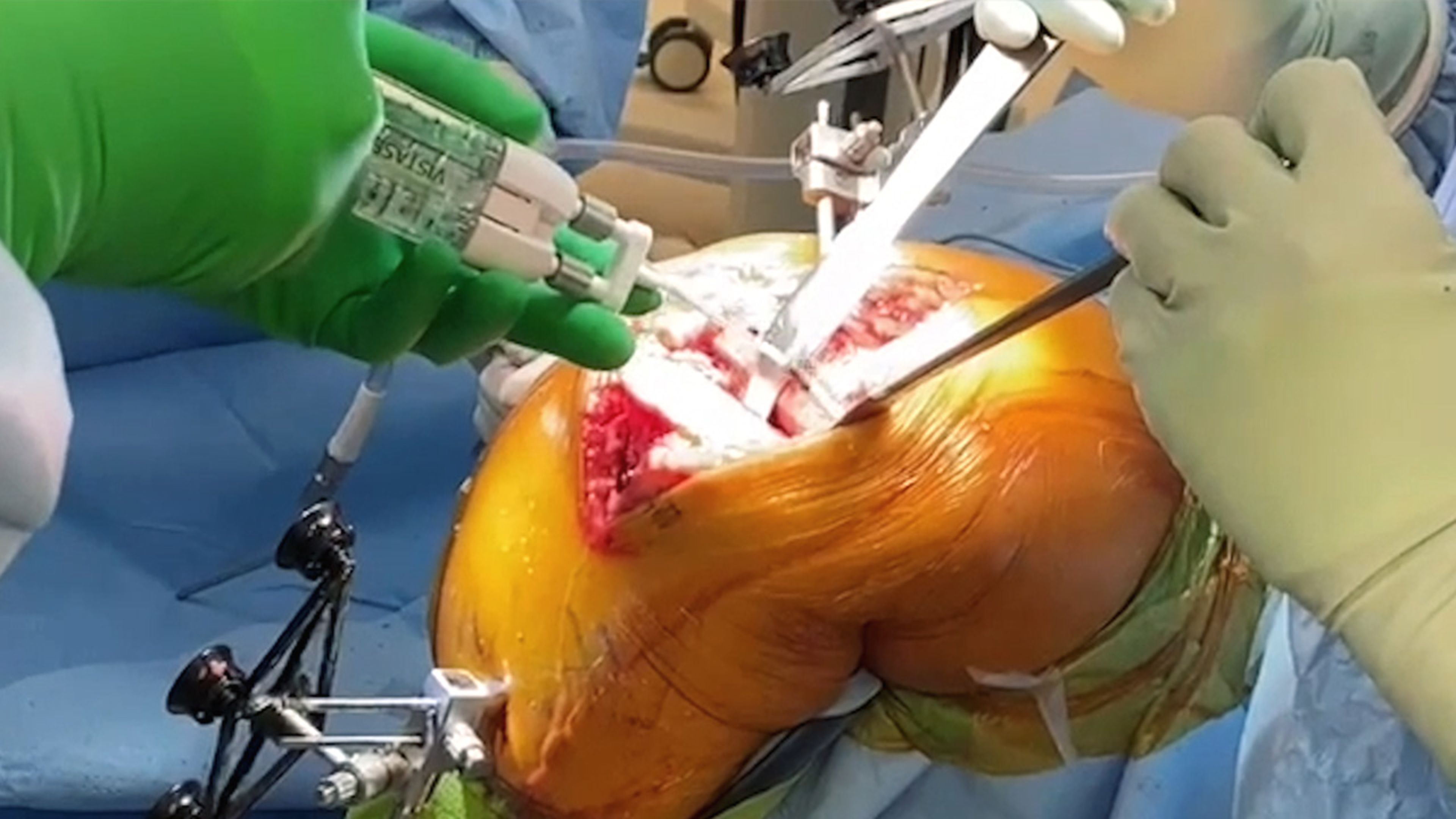 US_ETH_BIOS_221167.1 - Total Knee Surgery Using VISTASEAL™ Fibrin Sealant with Matthew Varacallo, MD