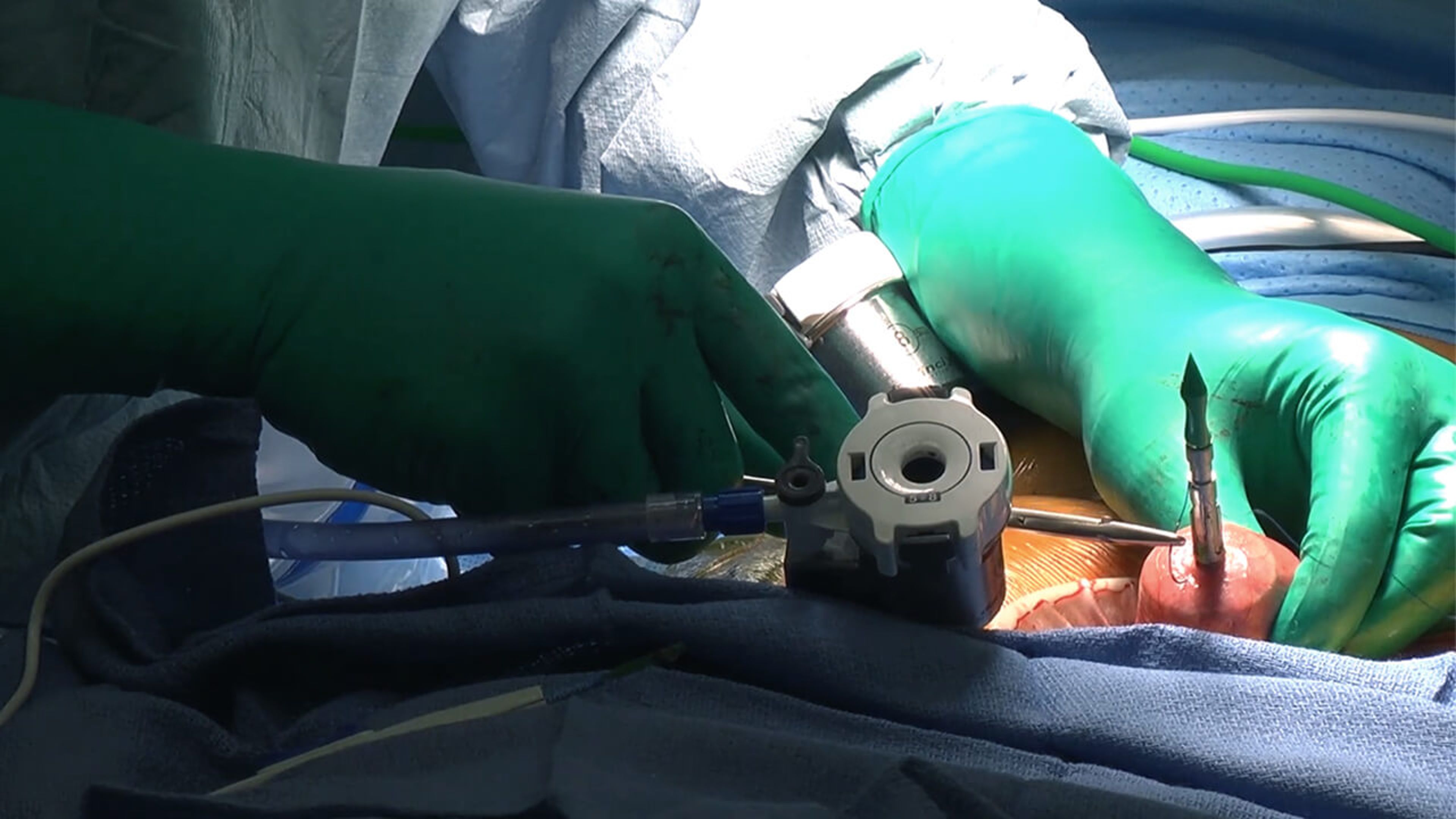 US_ETH_STAP_114172.1 - Total colectomy using the ECHELON CIRCULAR™ Powered Stapler with Ron Landmann, MD