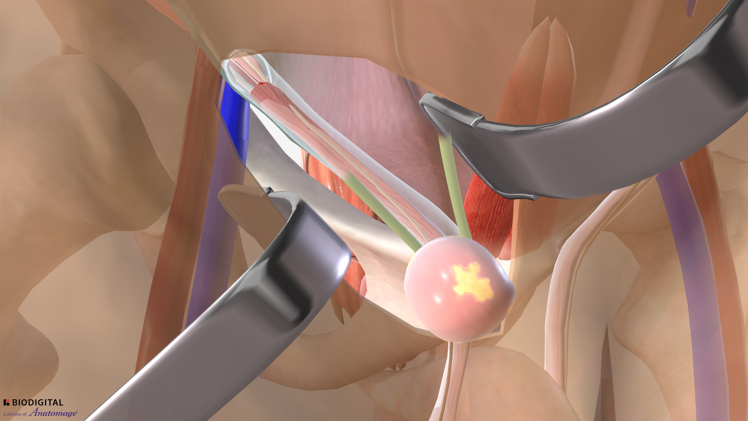 Inguinal hernia repair open