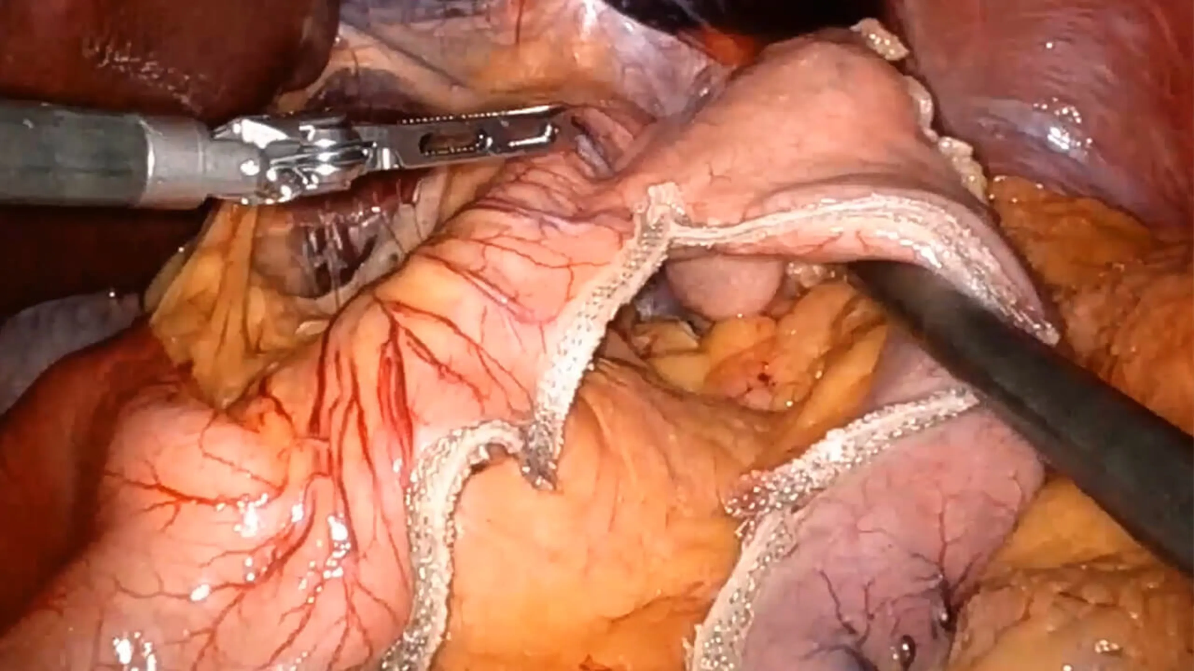 US_ETH_STAP_218590 - Robotic sleeve gastrectomy using ECHELON ENDOPATH™ Staple Line Reinforcement with Omar Bellorin-Marin, MD