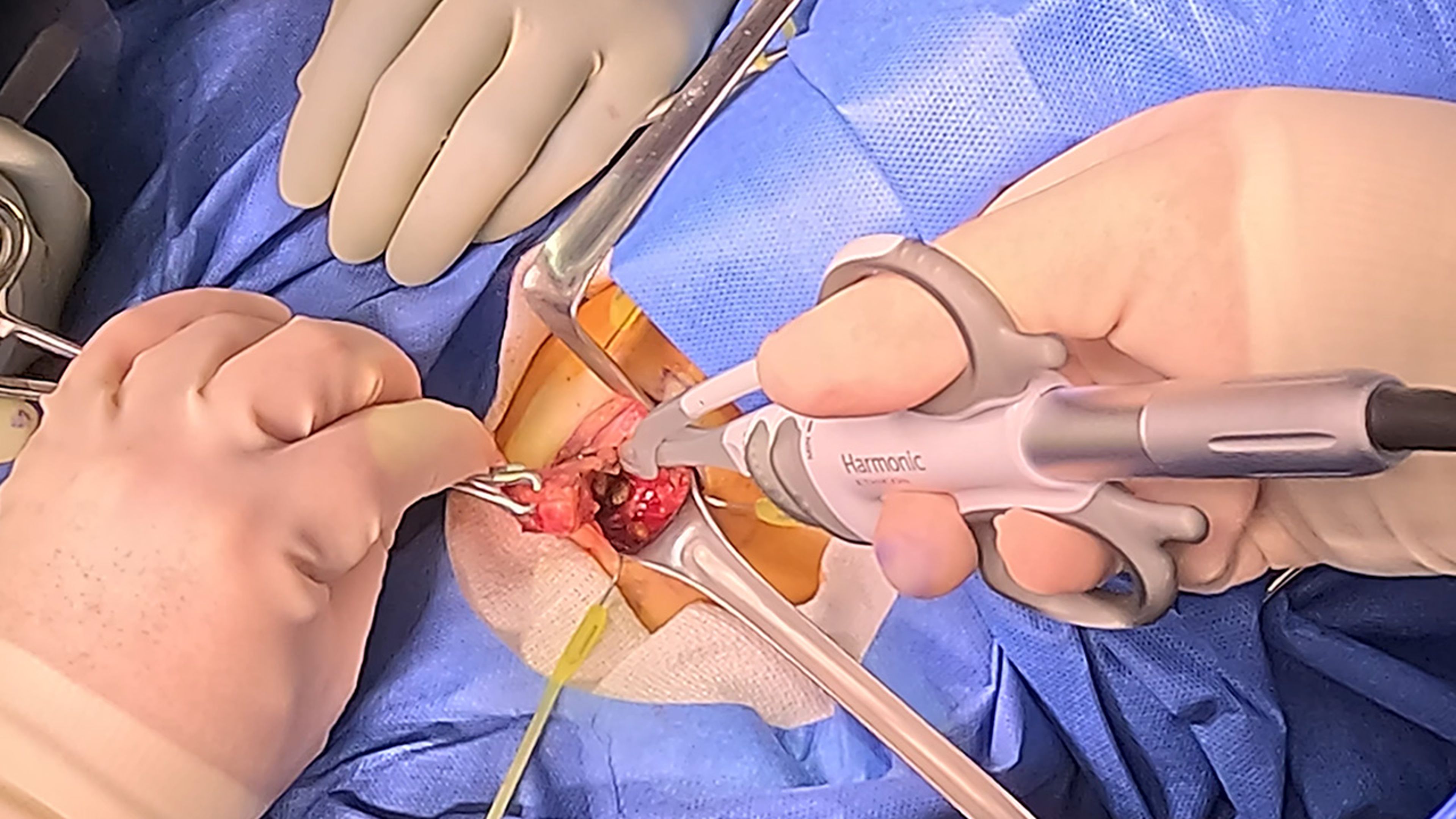 US_SRG_ENER_395141 - Left thyroidectomy using HARMONIC FOCUS™+ Shears and VISTASEAL™ Fibrin Sealant