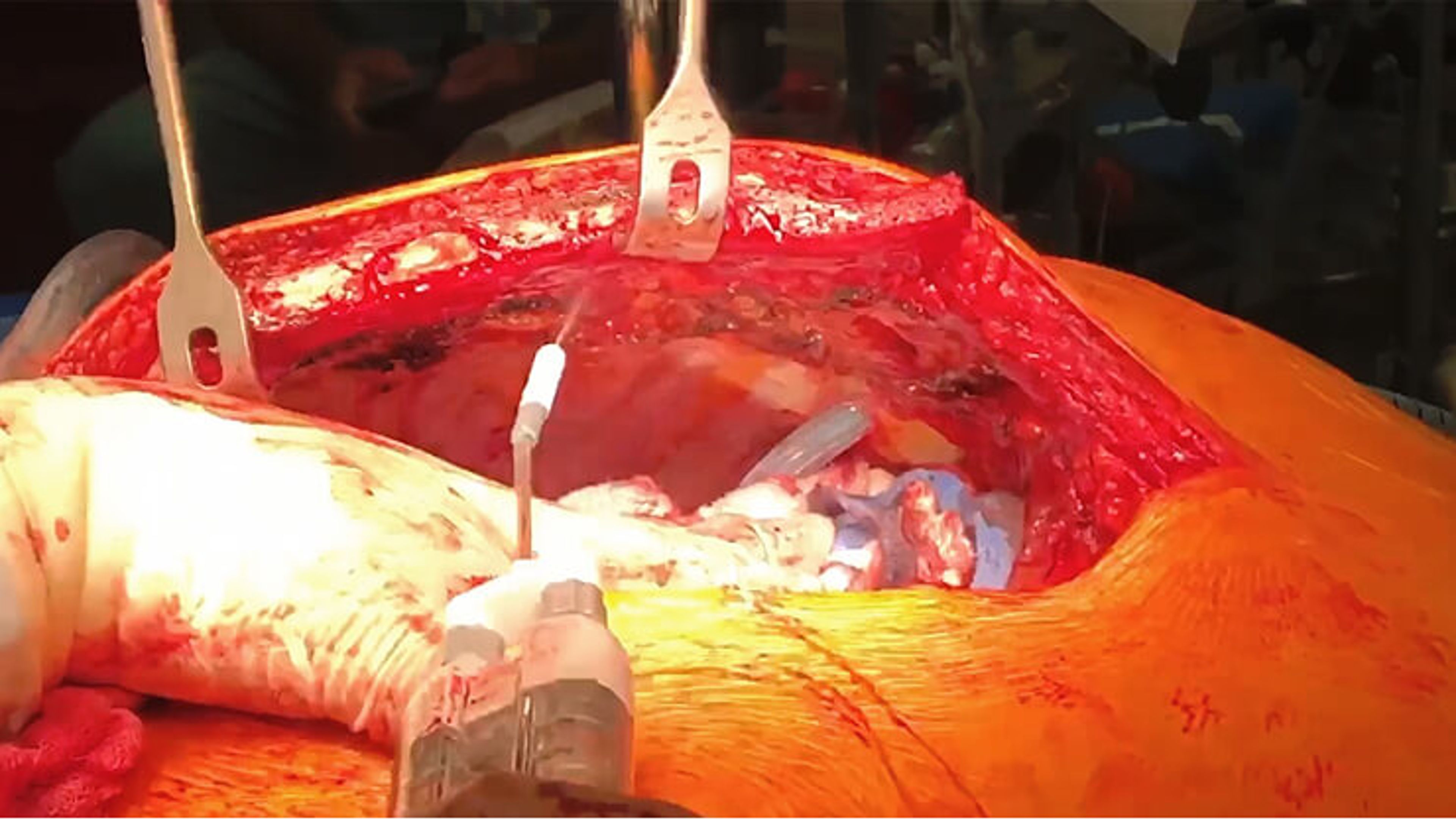 US_ETH_BIOS_221169.1 - Coronary artery bypass using VISTASEAL™ Fibrin Sealant with Reginald Abraham, MD