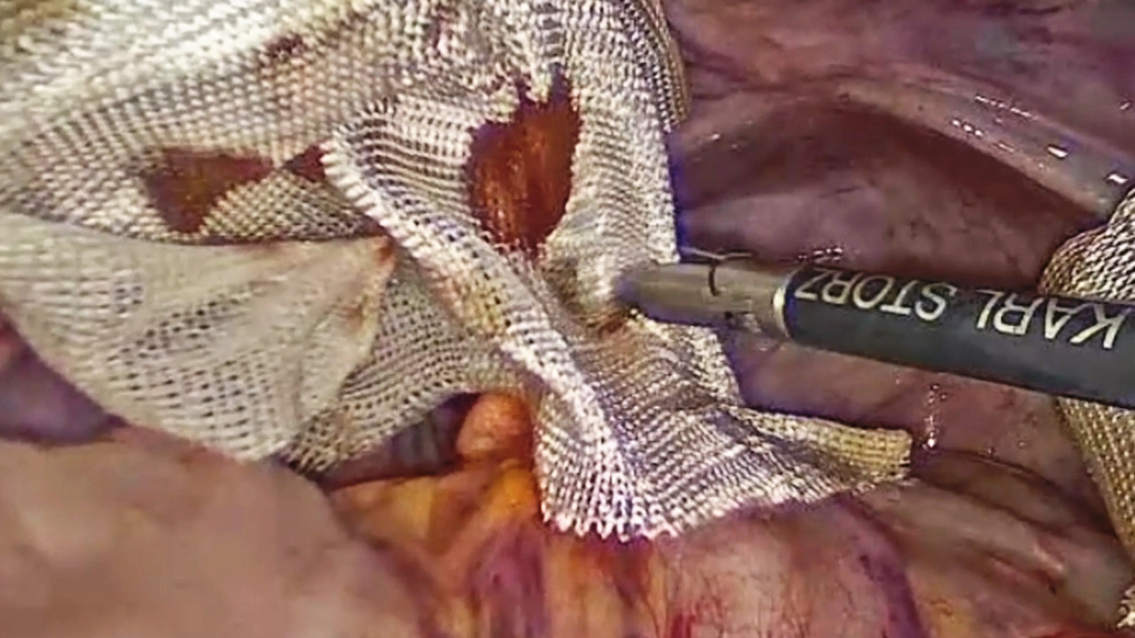 US_SRG_ENER_400481 - Ovarian cystectomy using HARMONIC™ 1100 Shears and GYNECARE INTERCEED™ with Kirsten Sasaki, MD