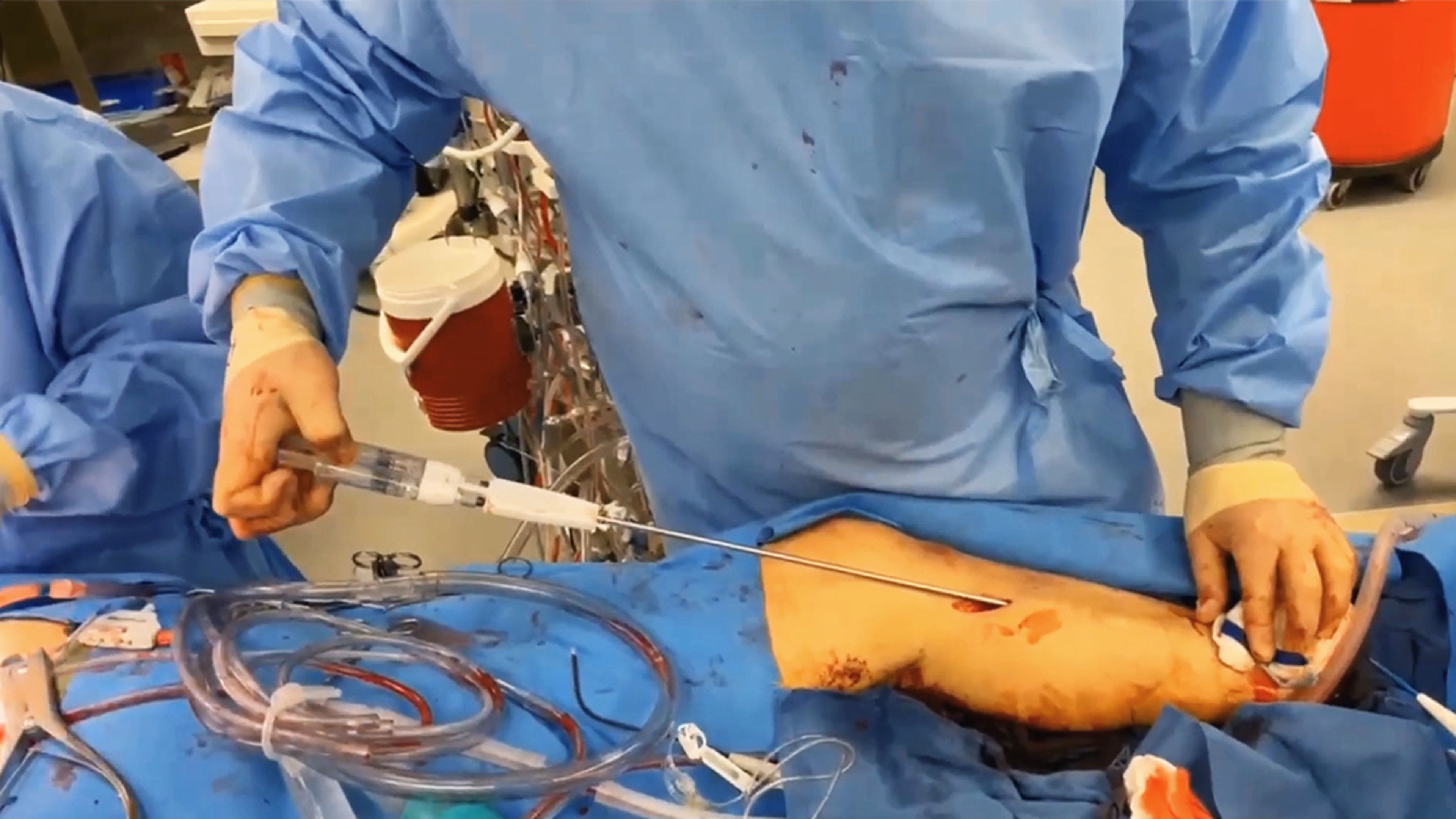 US_ETH_BIOS_221171.1 -  Endoscopic vein harvesting using VISTASEAL™ Fibrin Sealant with Tyler Ingram, PA-C
