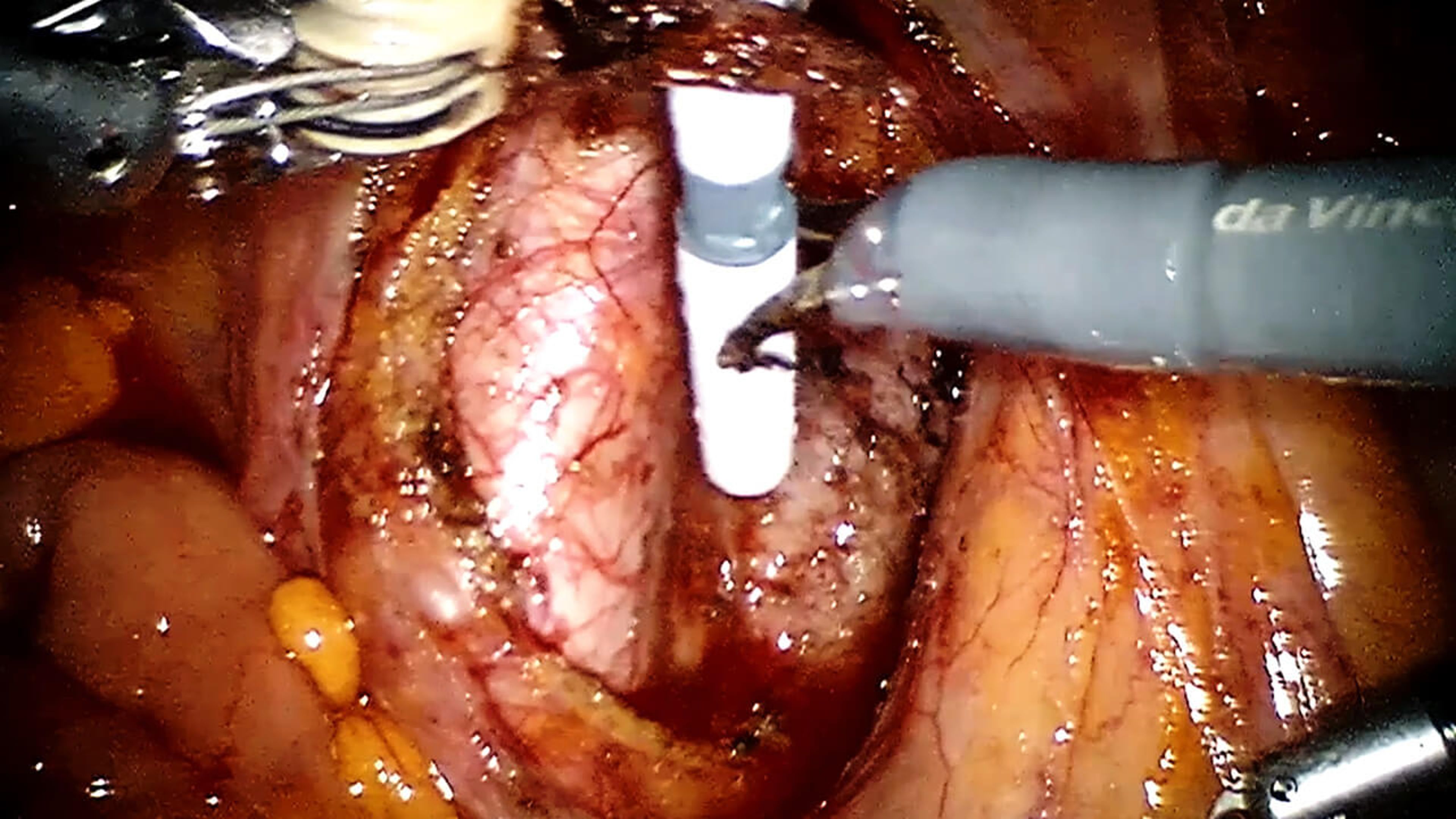 US_ETH_BIOS_119742.2 - Aortic dissection using VISTASEAL™ Fibrin Sealant with Michael Worley, Jr., MD