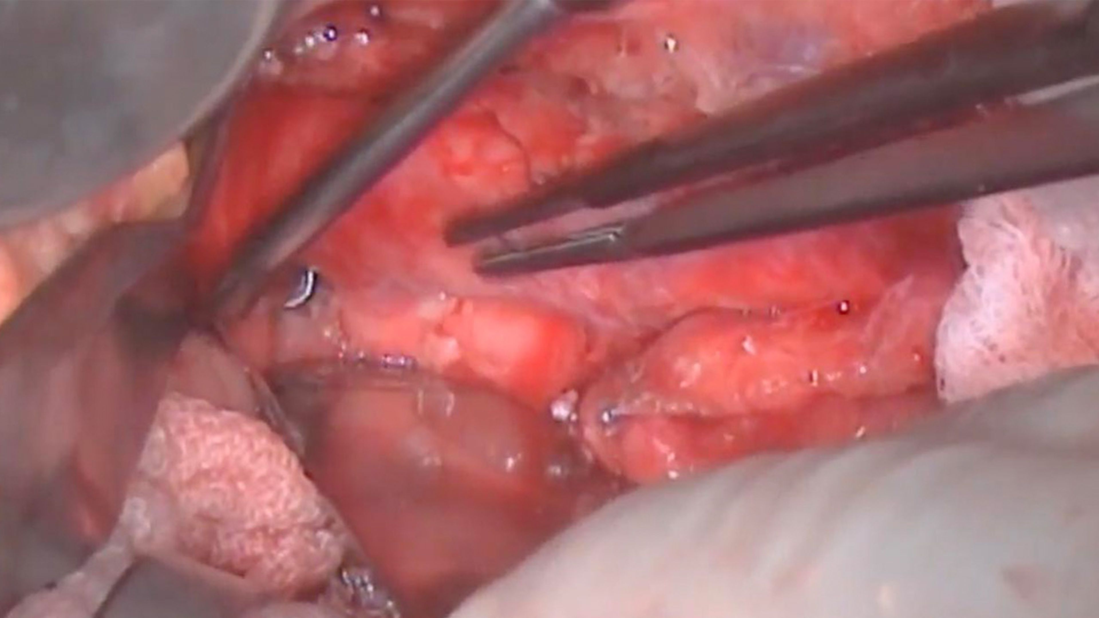 Infrarenal aortic dissection