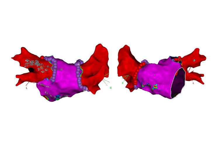 Dual Energy THERMOCOOL SMARTTOUCH™ SF Platform | J&J MedTech US
