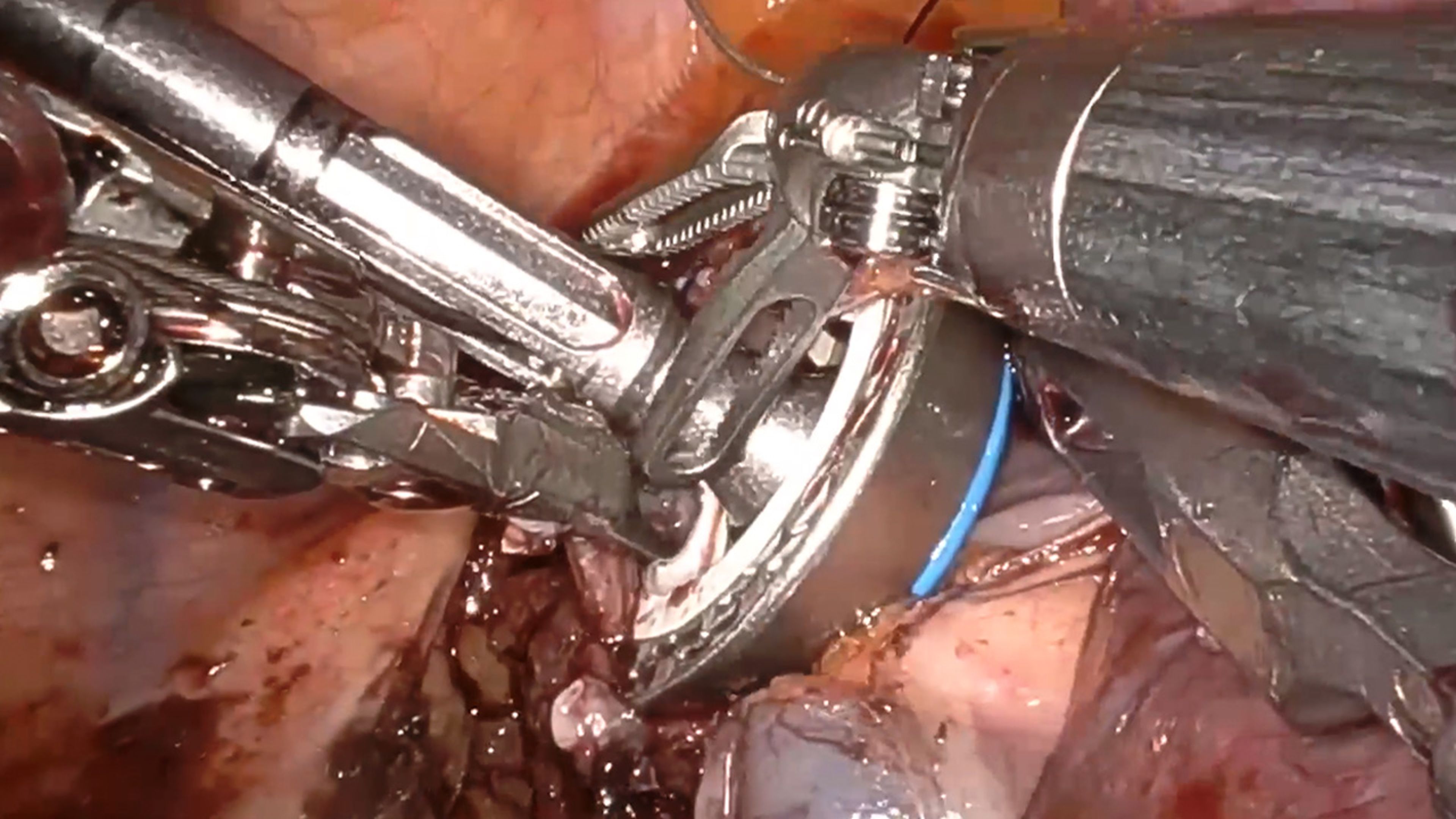 US_SRG_STAP_409239 - Robotic-assisted minimally invasive esophagectomy using the ECHELON CIRCULAR™ Powered Stapler with Olugbenga Okusanya, MD