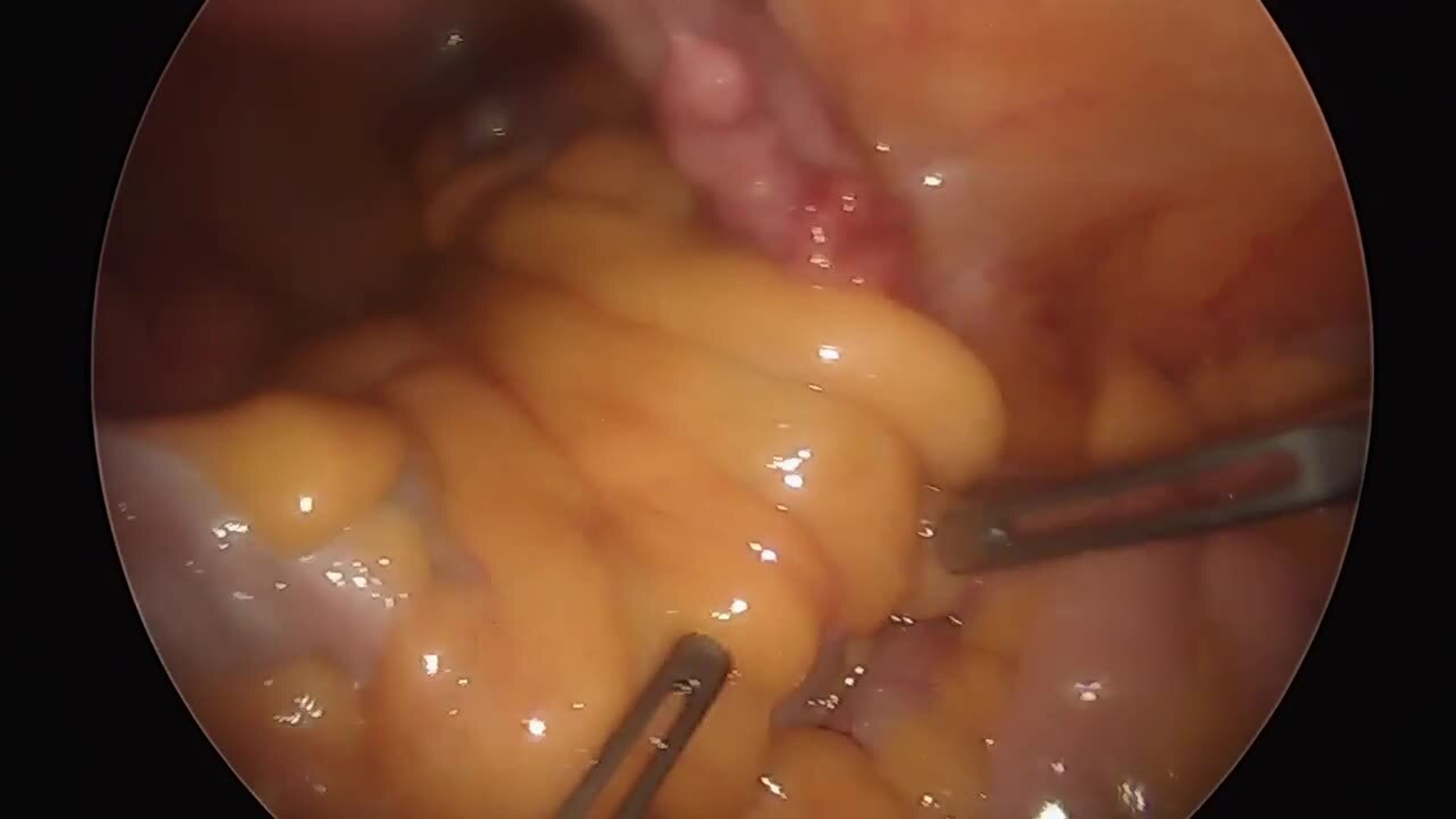 Total laparoscopic hysterectomy