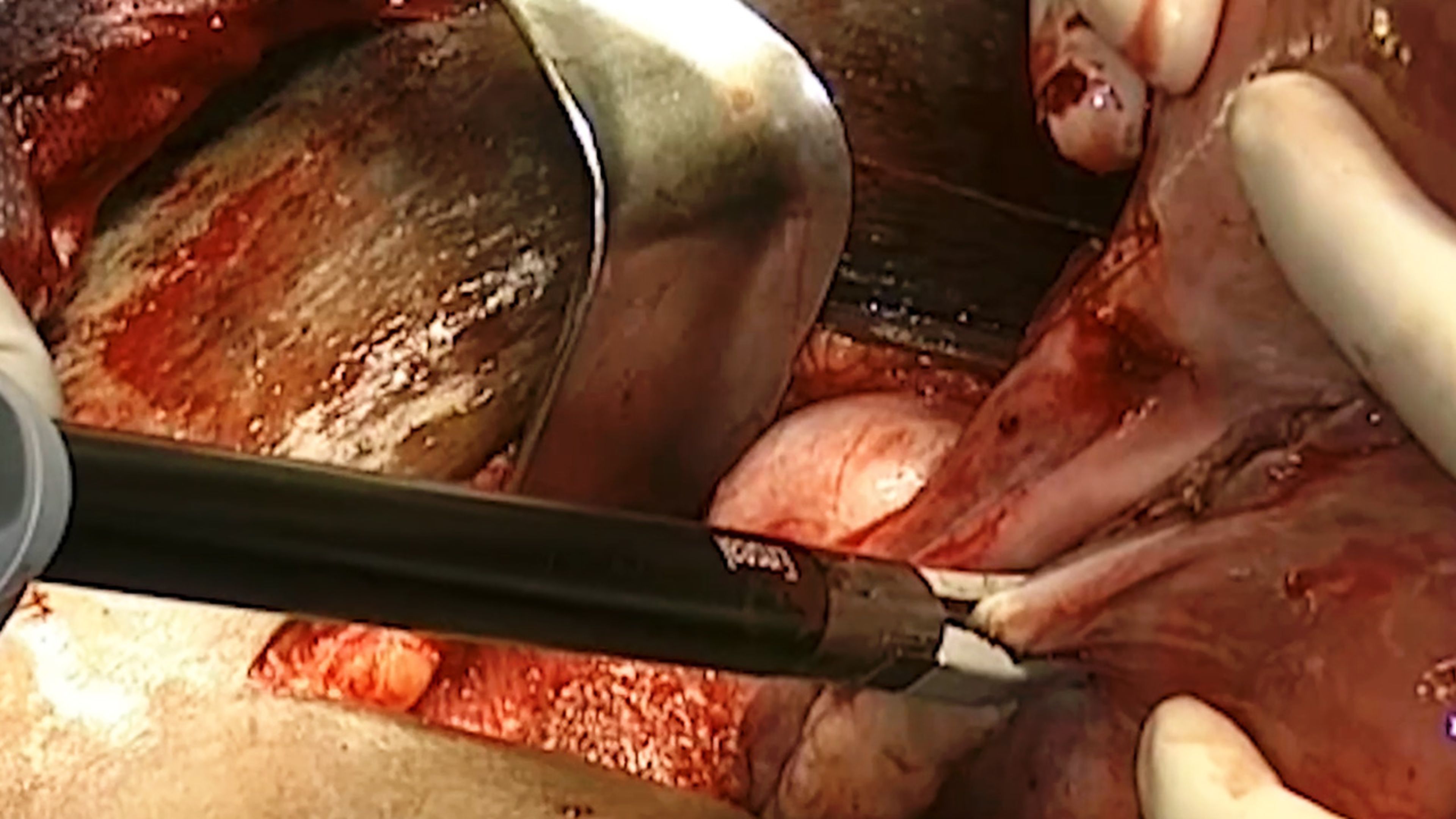 C_US_SRG_ENER_140630.EN - Total Abdominal Hysterectomy Using the Enseal™ X1 Large Jaw Tissue Sealer with Steven Mccarus, MD