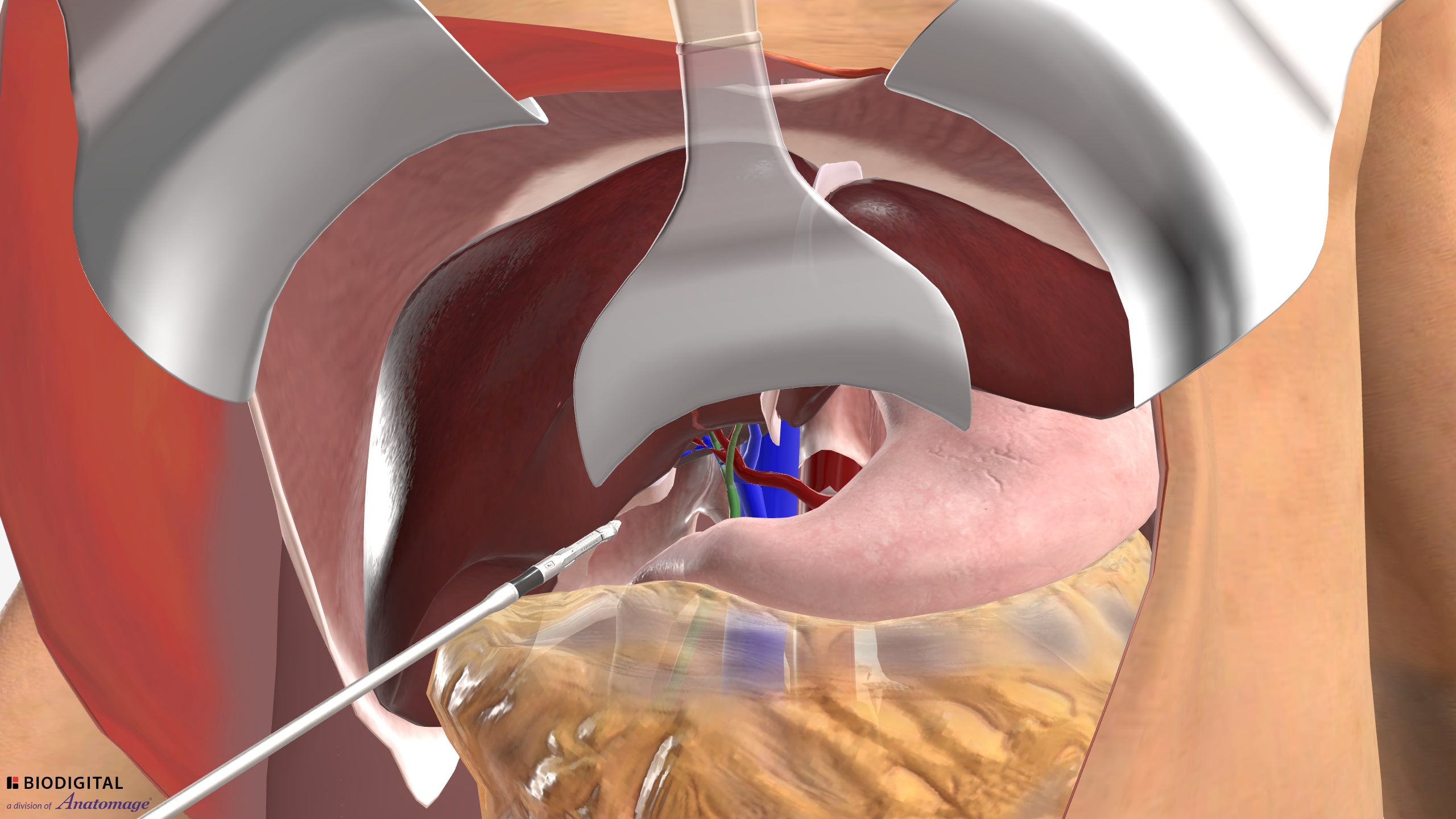 Right Hepatectomy 3D Model
