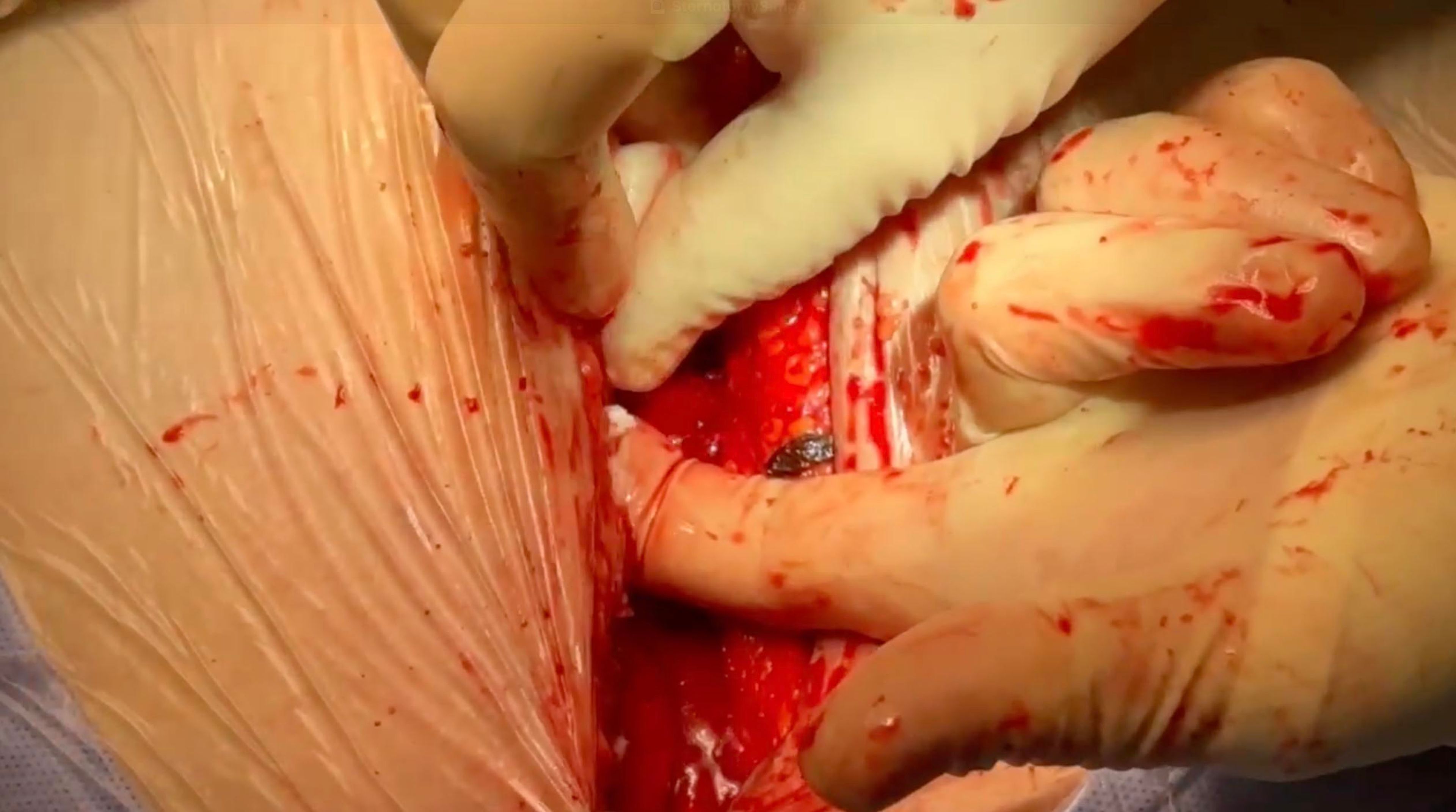 Sternal edge hemostasis