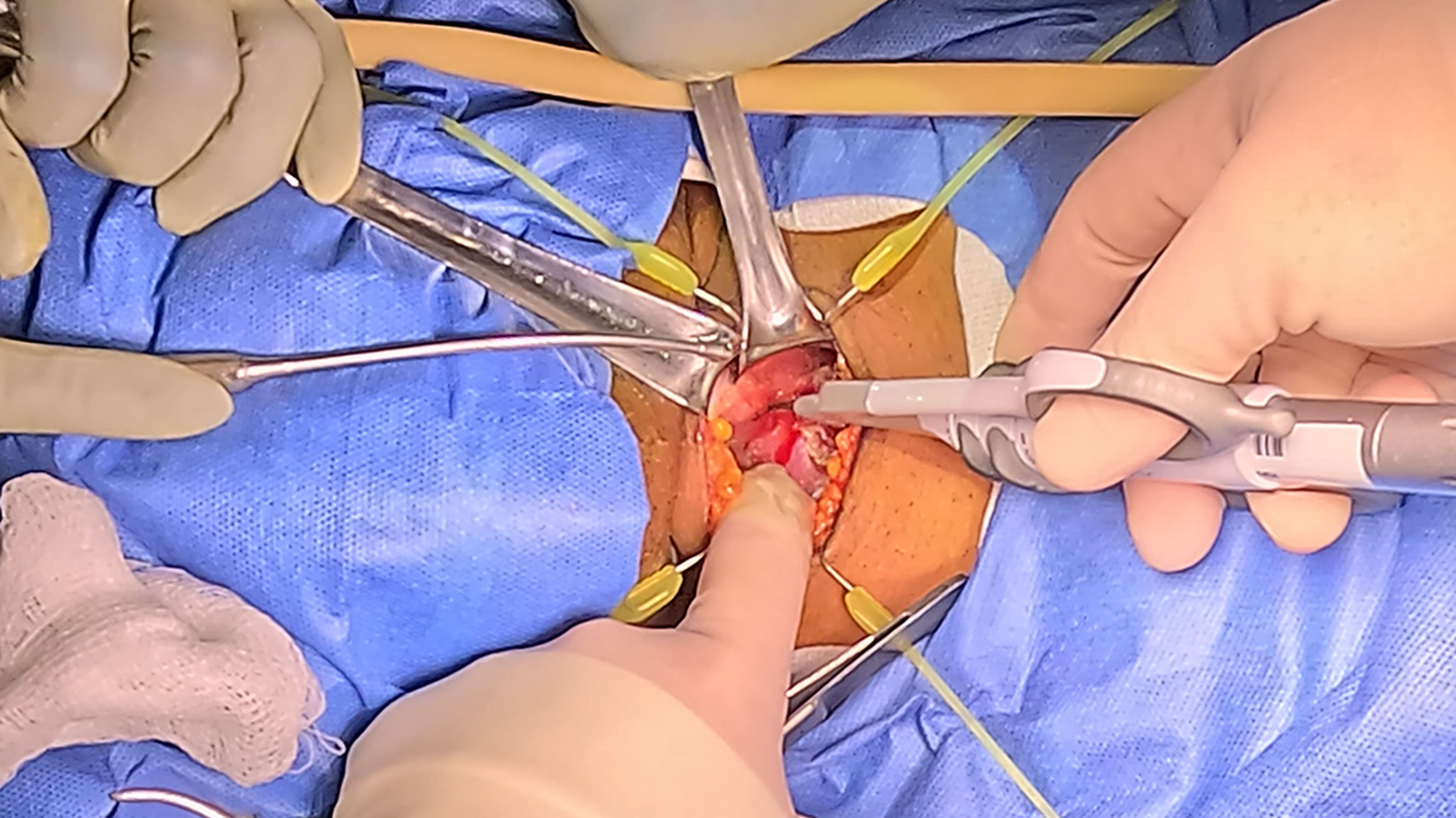 US_SRG_ENER_395886 - Parathyroidectomy using HARMONIC FOCUS™+ Shears
