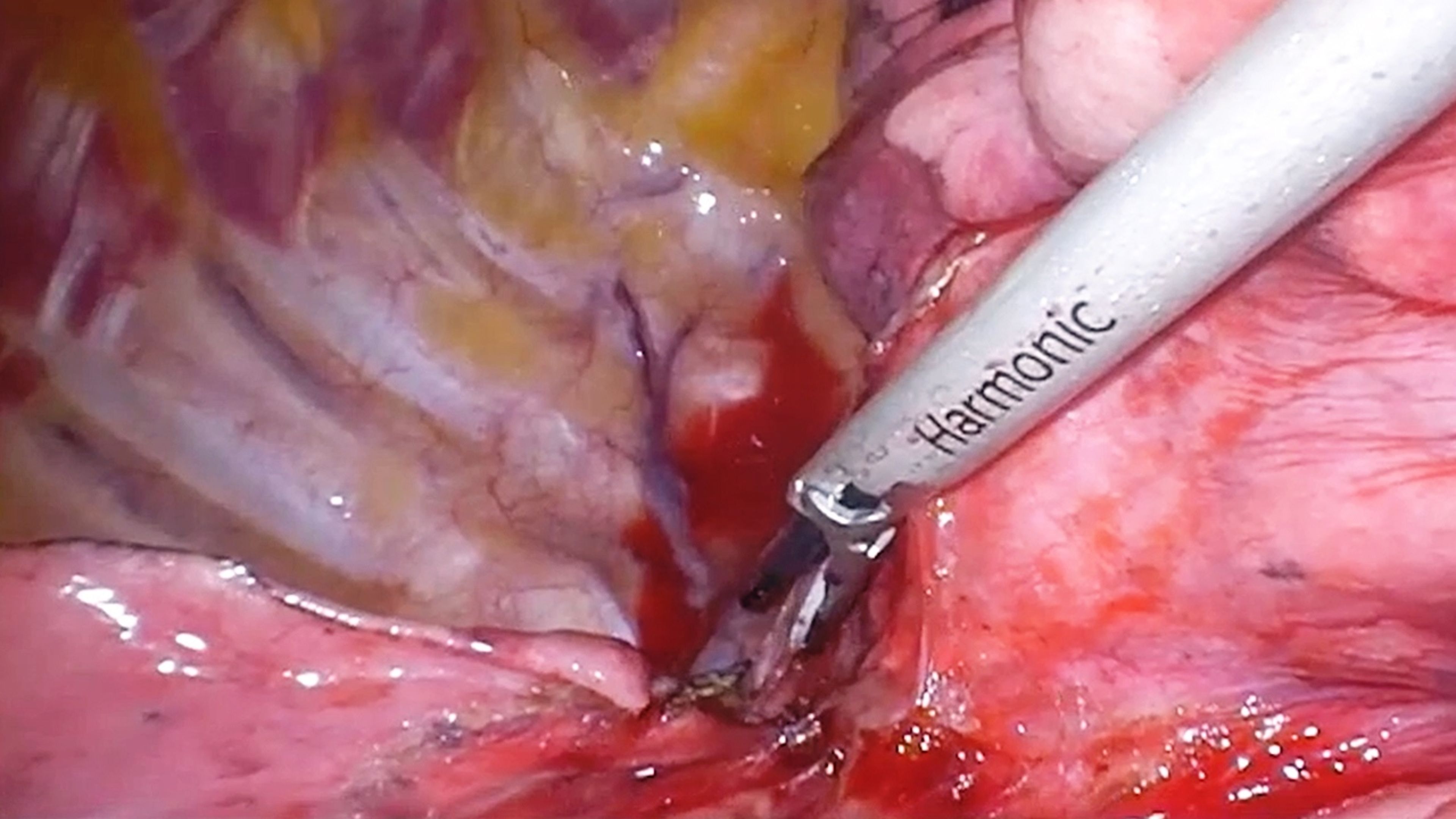 US_ETH_ENER_367175 - VATS lobectomy using HARMONIC™ 1100 Shears, ECHELON FLEX™ Powered Vascular Stapler, and SURGICEL™ Absorbable Hemostat with Zane Hammoud, MD