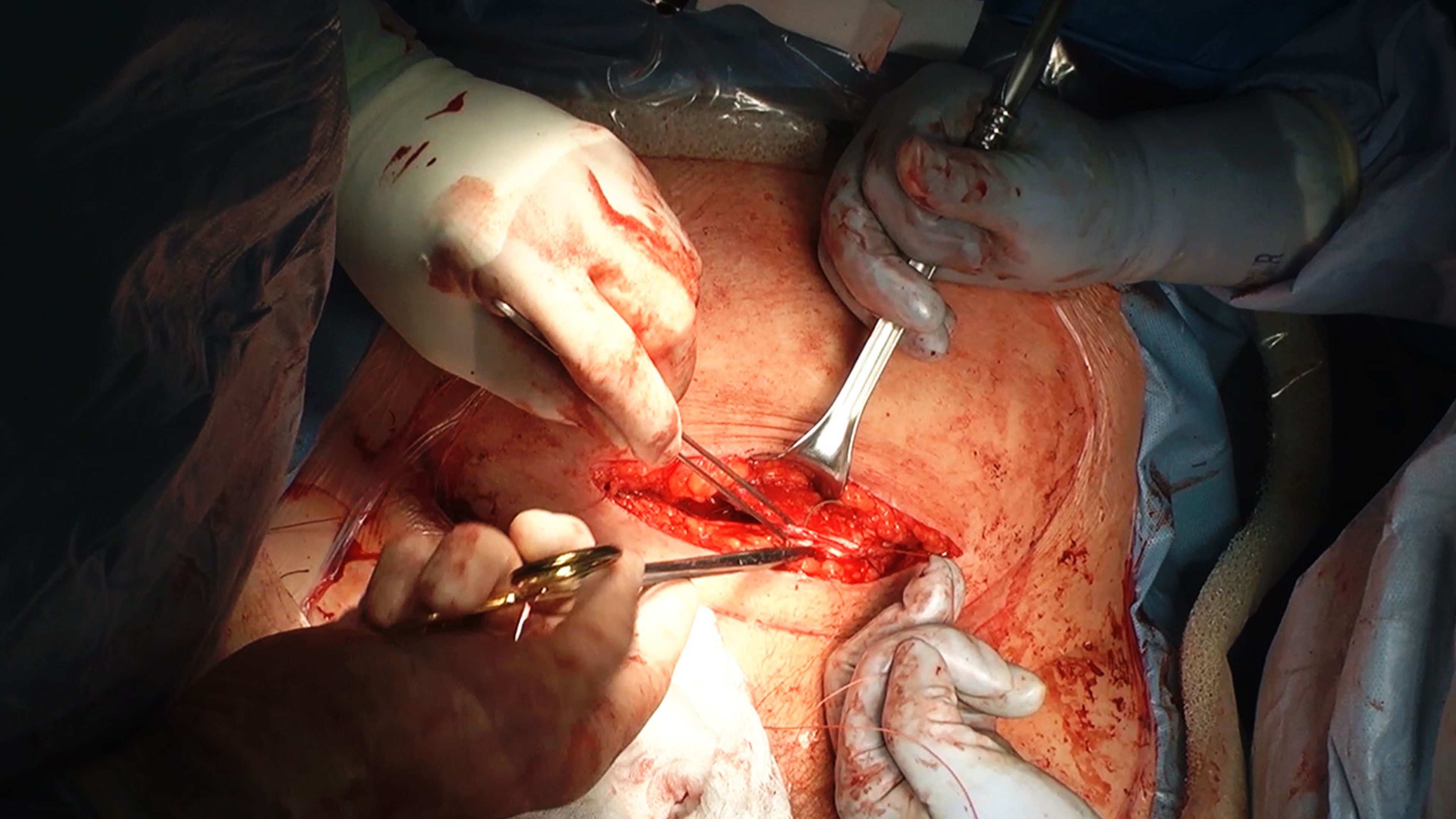 US_ETH_WOUN_112022 - C-section wound closure using STRATAFIX™ Spiral Knotless Tissue Control Device and DERMABOND™ PRINEO™ Skin Closure System with Russell Stankiewicz, MD