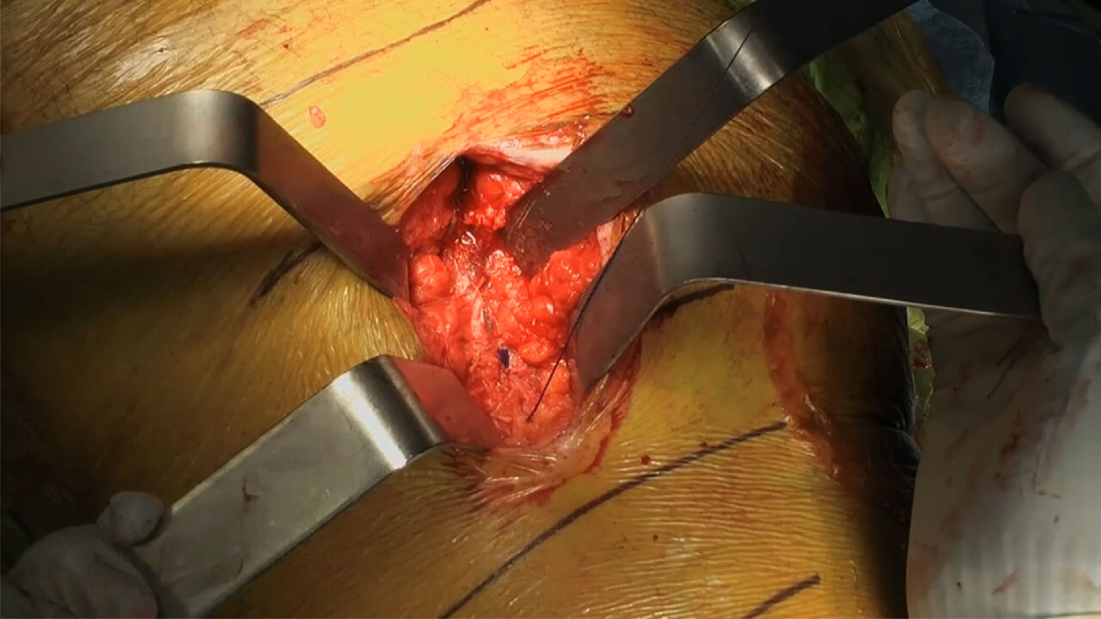 US_SRG_WOUN_108588.1 - Total hip arthroplasty closure using STRATAFIX™ Symmetric PDS™ Plus and DERMABOND™ PRINEO™ Skin Closure System with Ryan Nunley, MD