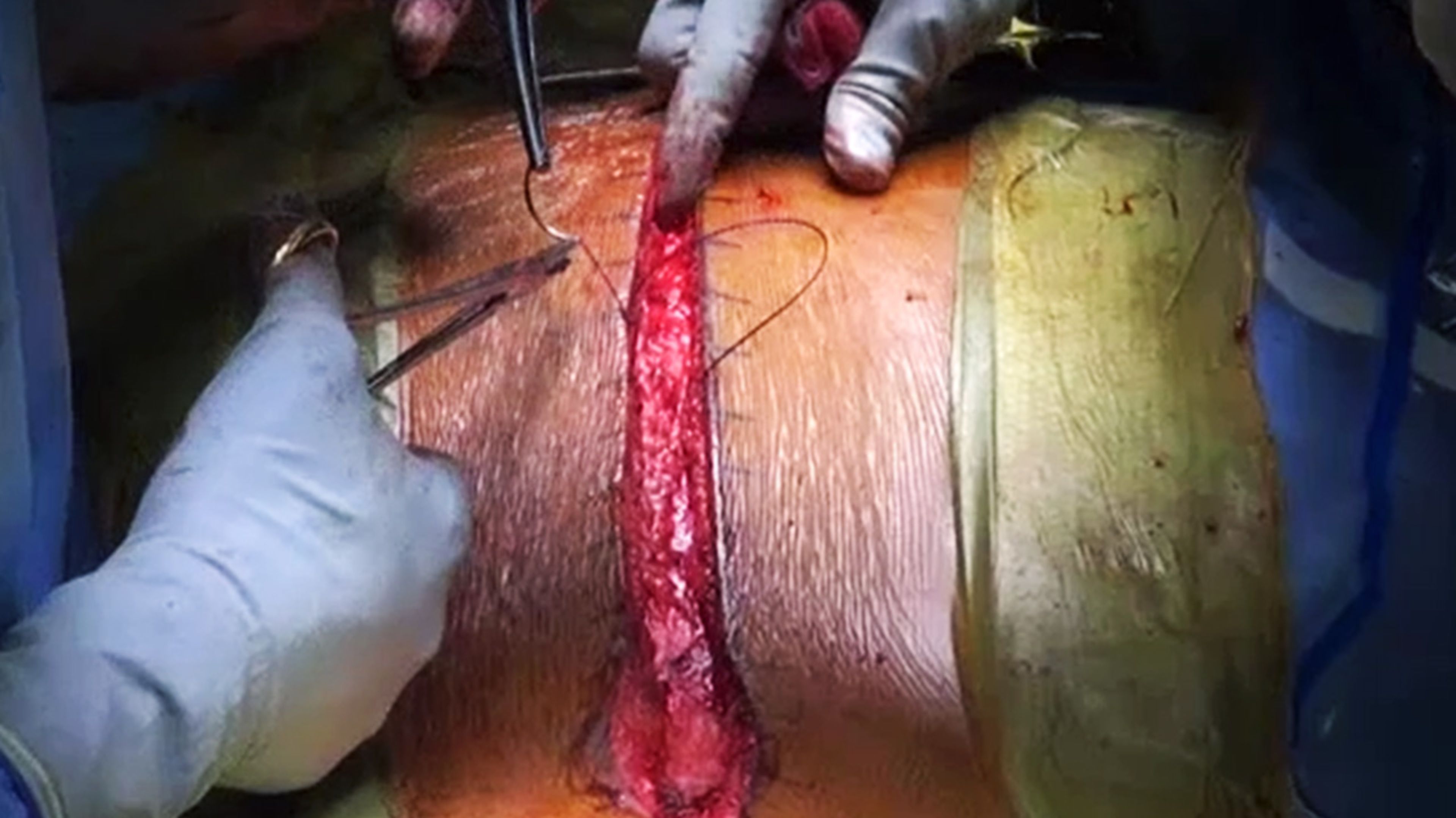US_SRG_WOUN_129393.1 - Spinal fusion wound closure using STRATAFIX™ Symmetric Antibacterial Barbed Suture with Suken Shah, MD