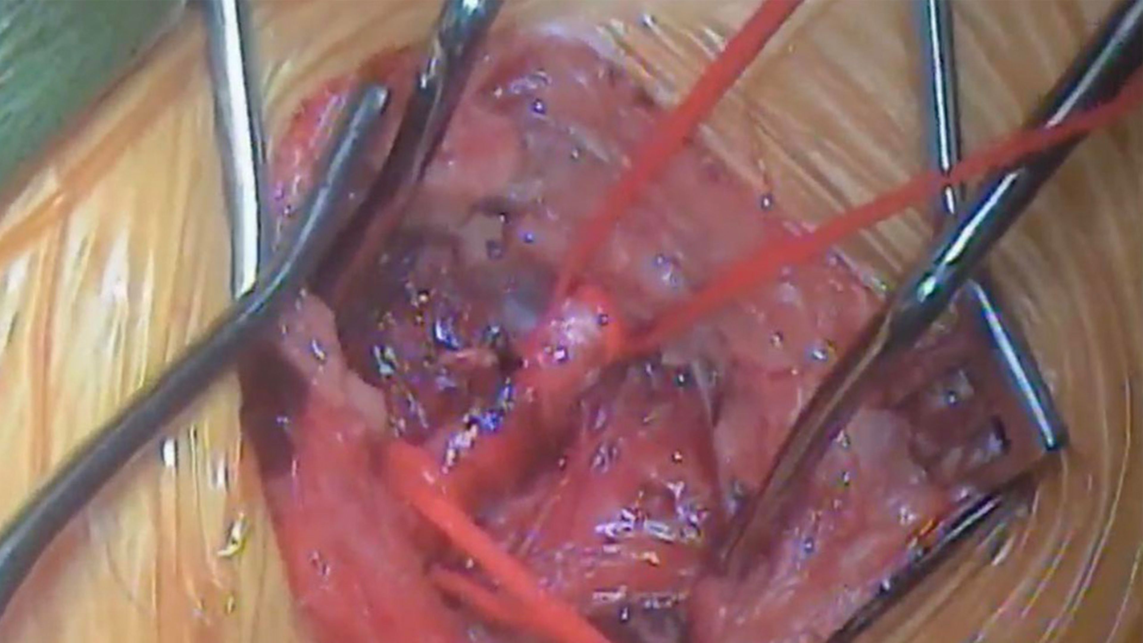Femoral arteries encircled