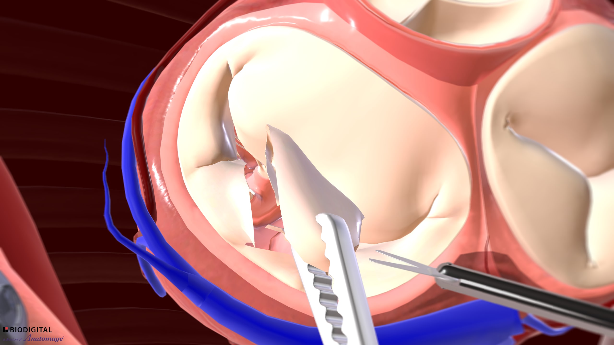 Relevant anatomy for mitral valve repair