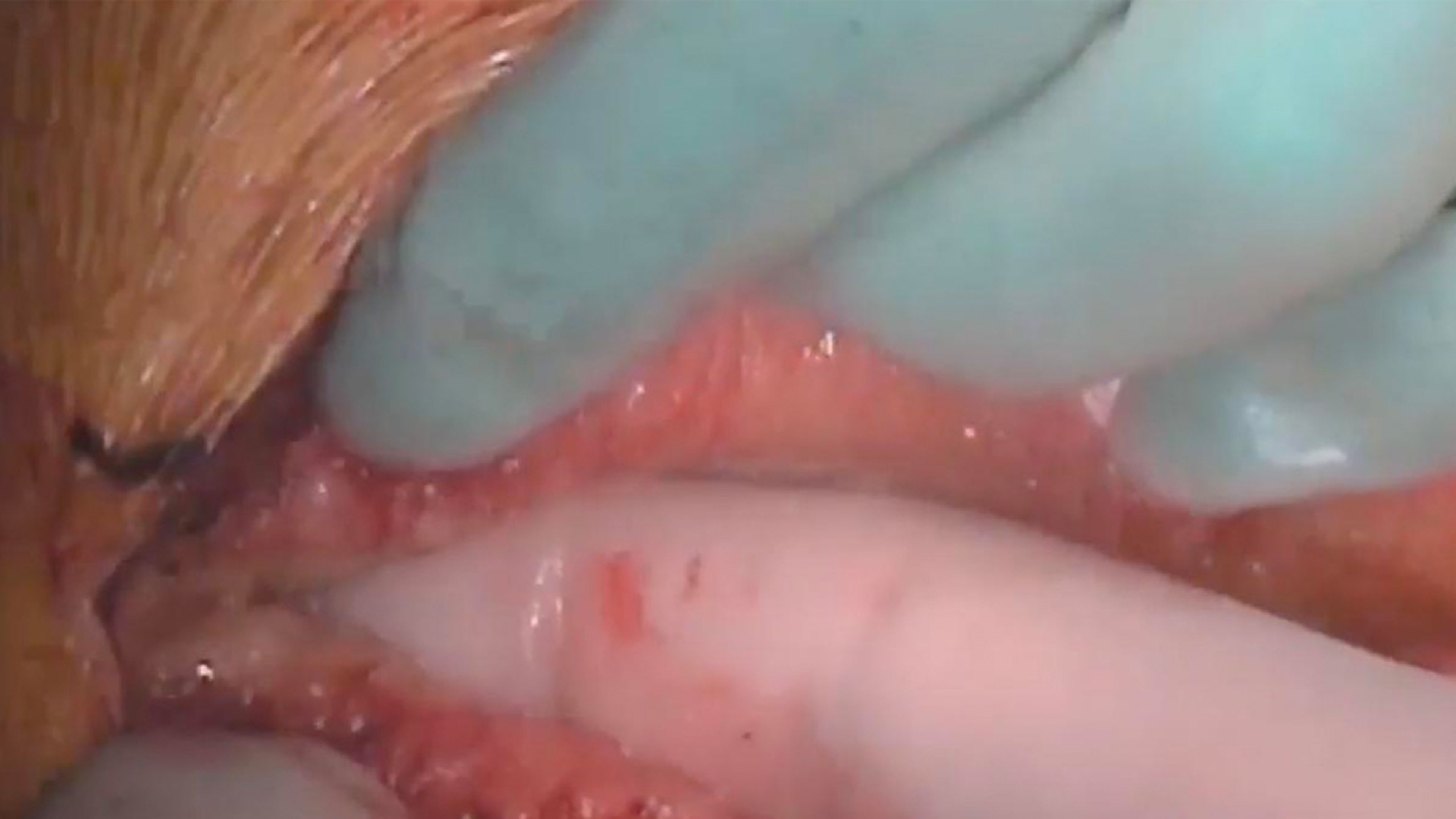 Abdominal cavity exploration