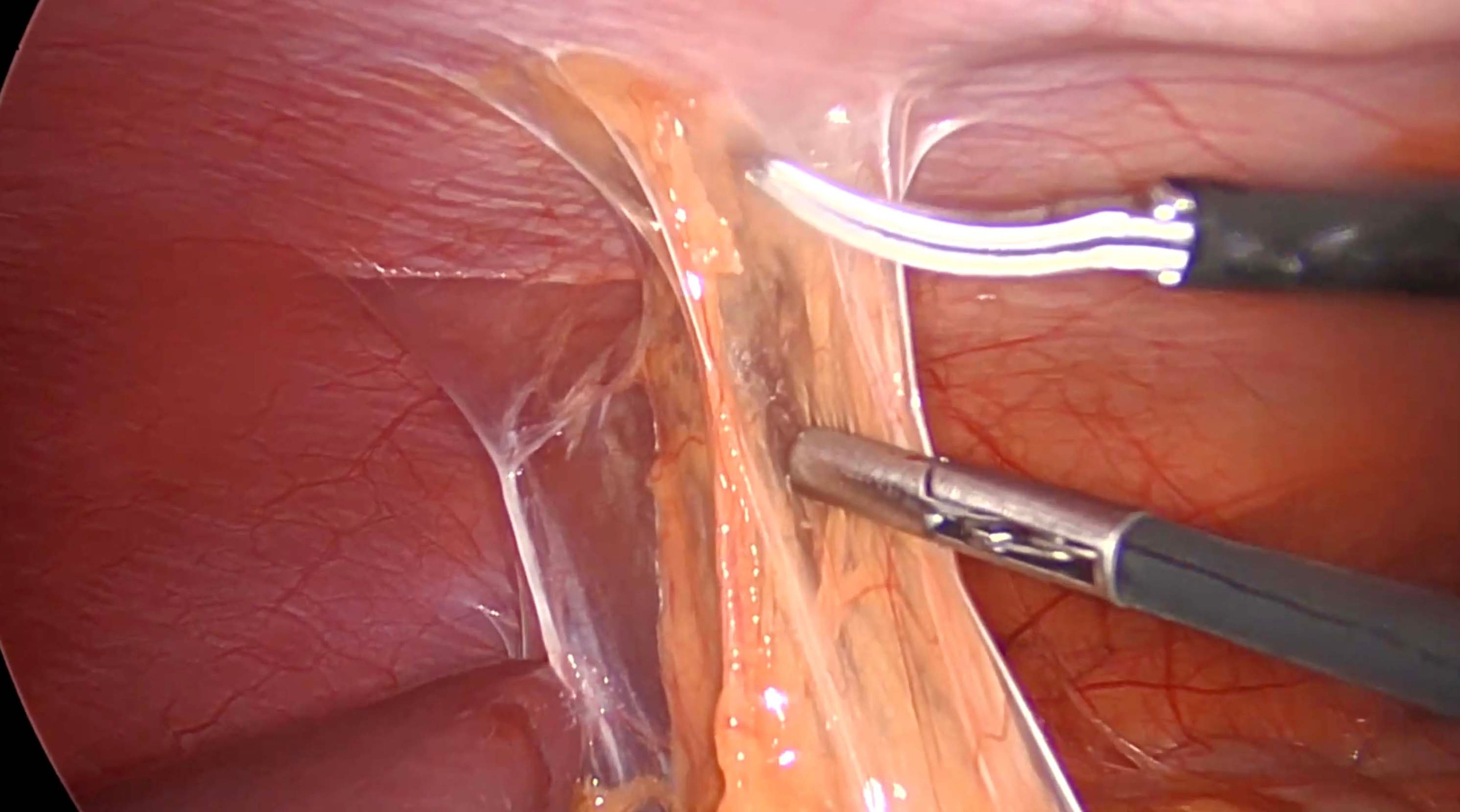 left colon, splenic flexure mobilized