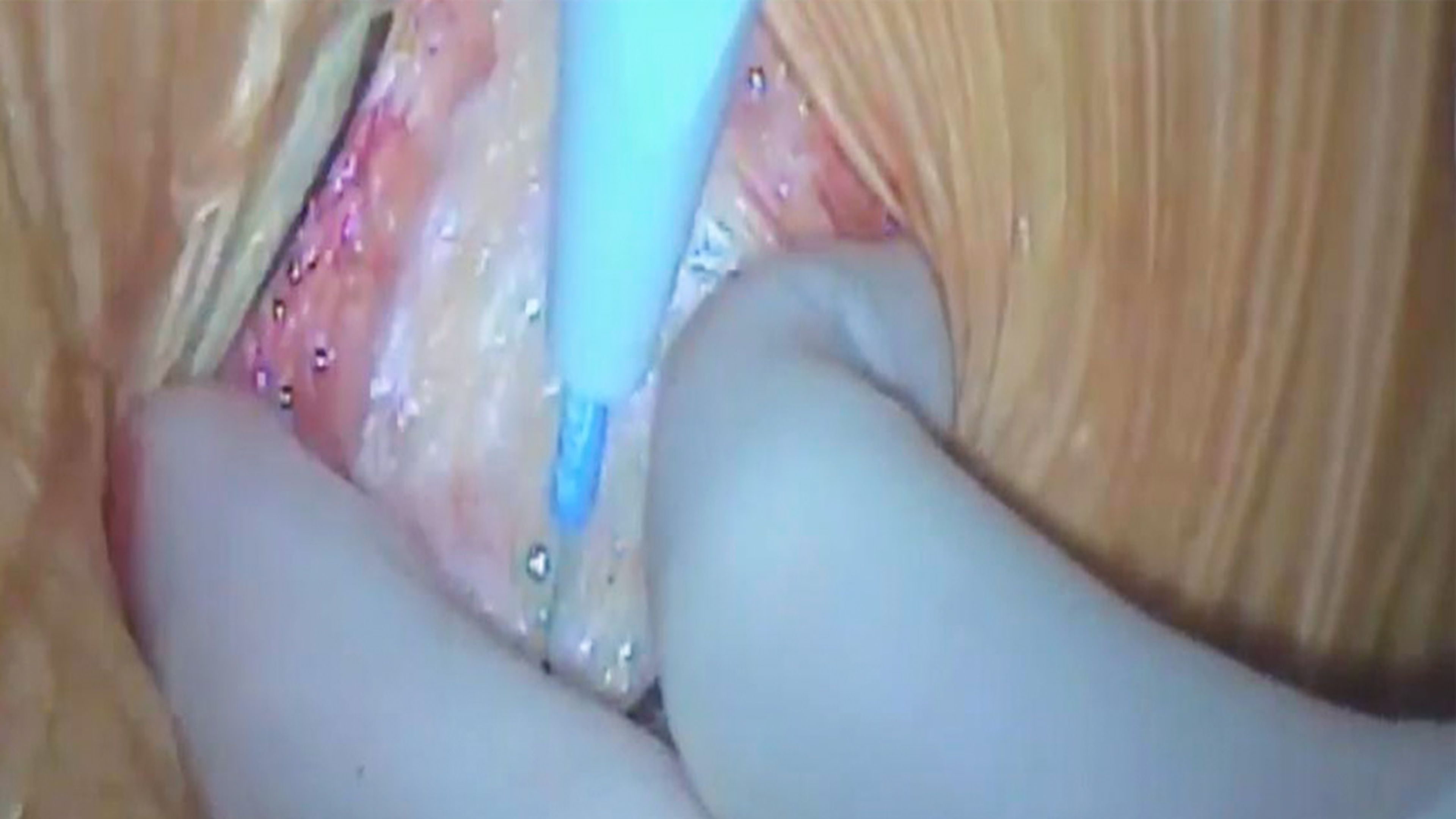 Skin incision